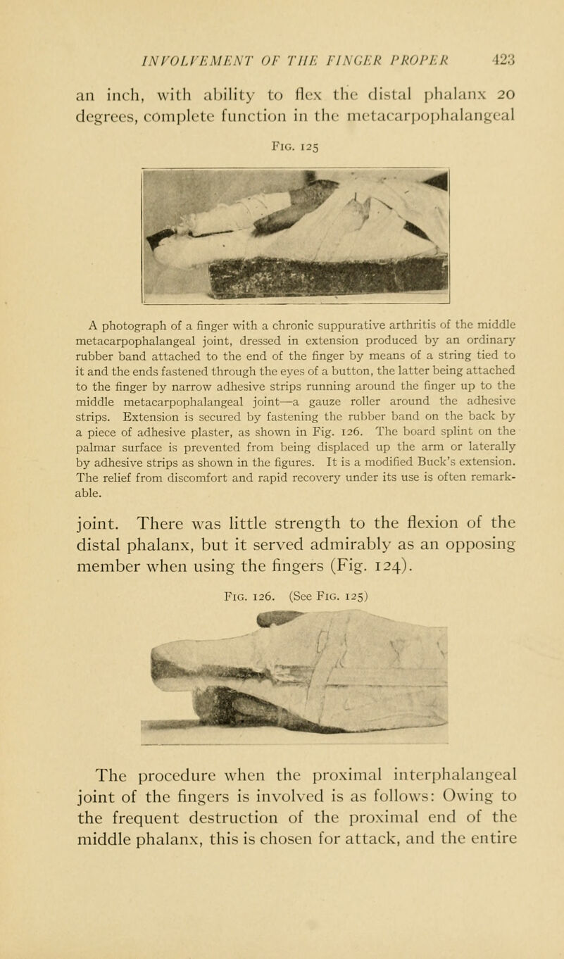 an inrh, with ability to flex the distal i)lialanx 20 degrees, complete function in the metacarpophalangeal Fig. 125 A photograph of a finger with a chronic suppurative arthritis of the middle metacarpophalangeal joint, dressed in extension produced by an ordinary- rubber band attached to the end of the finger by means of a string tied to it and the ends fastened through the eyes of a button, the latter being attached to the finger by narrow adhesive strips running around the finger up to the middle metacarpophalangeal joint—a gauze roller around the adhesive strips. Extension is secured by fastening the rubber band on the back by a piece of adhesive plaster, as shown in Fig. 126. The board splint on the palmar surface is prevented from being displaced up the arm or laterally by adhesive strips as shown in the figures. It is a modified Buck's extension. The relief from discomfort and rapid recovery under its use is often remark- able. joint. There was little strength to the flexion of the distal phalanx, but it served admirably as an opposing member when using the fingers (Fig. 124). Fig. 126. (See Fig. 125) The procedure when the proximal interphalangeal joint of the fingers is involved is as follows: Owing to the frequent destruction of the proximal end of the middle phalanx, this is chosen for attack, and the entire