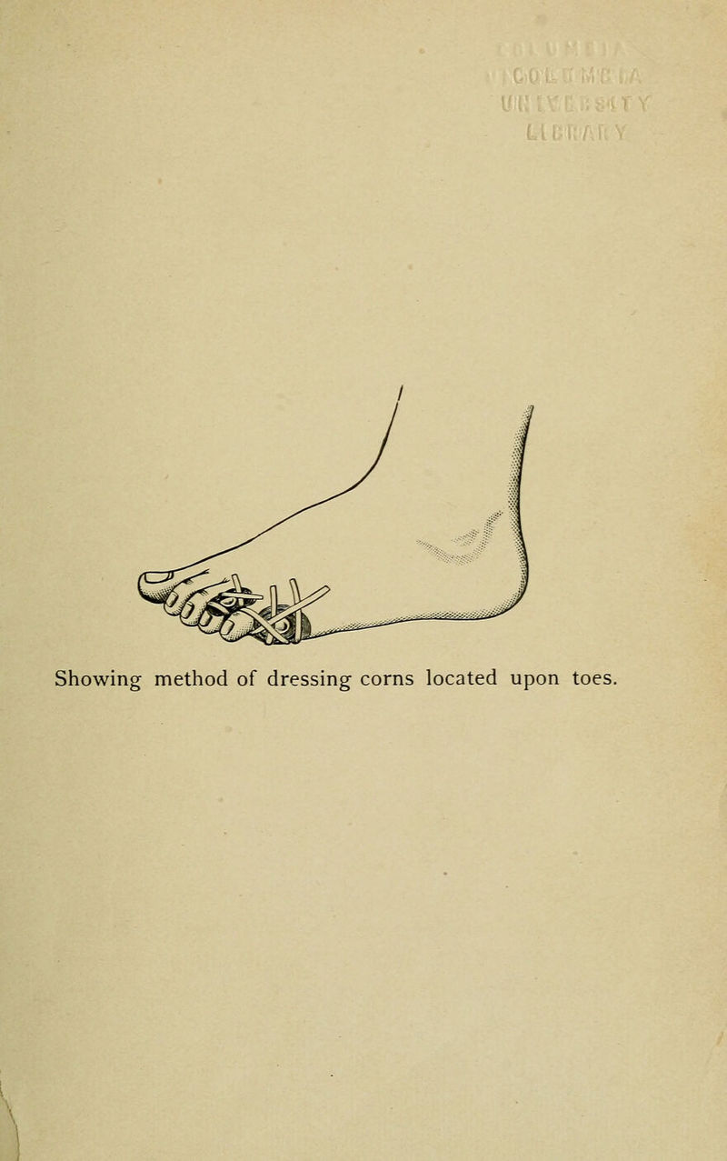 Showing method of dressing corns located upon toes.