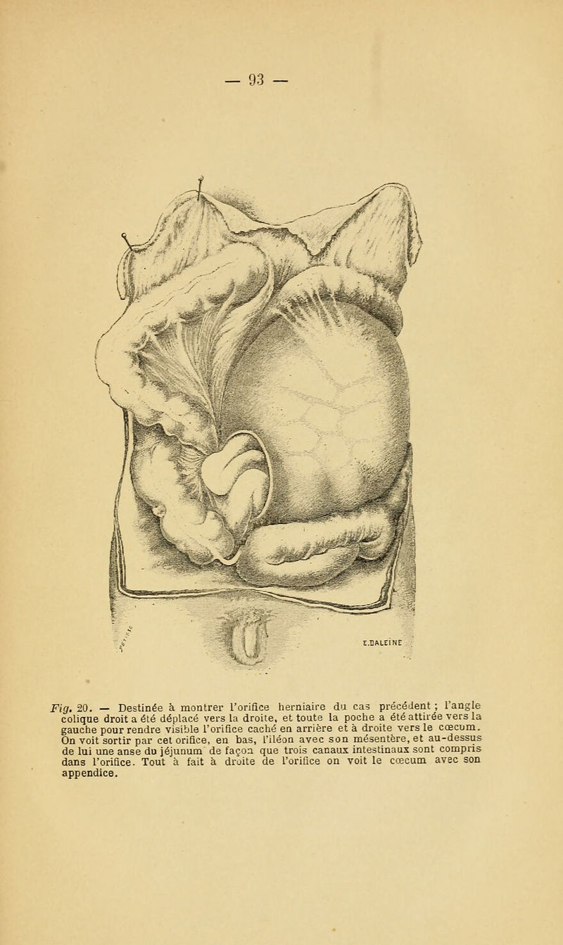 Fig. 20. — Destinée à montrer l'orifice herniaire du cas précédent ; l'angle colique droit a été déplacé vers la droite, et toute la poche a été attirée vers la gauche pour rendre visible l'orifice caché en arrière et à droite vers le cœcum. On voit sortir par cet orifice, en bas, l'iléon avec son mésentère, et au-dessus de lui une anse du jéjunum de façon que trois canaux intestinaux sont compris dans l'orifice. Tout à fait à droite de l'orifice on voit le cœcum avec son appendice.
