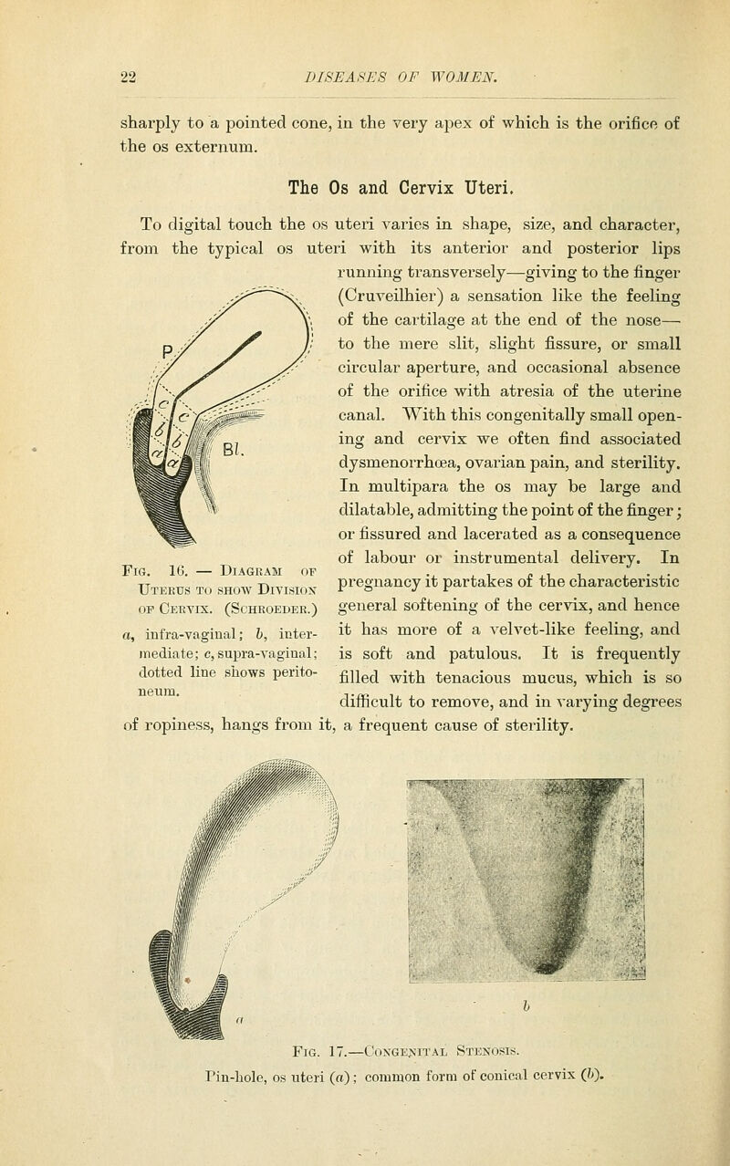 sharply to a pointed cone, in the very apex of which is the orifice of the OS externum. The Os and Cervix Uteri. To digital touch the os uteri varies in shape, size, and character, from the typical os uteri with its anterior and posterior lips running transversely—giving to the finger (Cruveilhier) a sensation like the feeling of the cartilage at the end of the nose—■ to the mere slit, slight fissure, or small circular aperture, and occasional absence of the orifice with atresia of the uterine canal. With this congenitally small open- ing and cervix we often find associated dysmenorrhcea, ovarian pain, and sterility. In multipara the os may be large and dilatable, admitting the point of the finger; or fissured and lacerated as a consequence of labour or instrumental delivery. In pregnancy it partakes of the characteristic general softening of the cervix, and hence it has more of a velvet-like feeling, and is soft and patulous. It is frequently filled with tenacious mucus, which is so difficult to remove, and in varying degrees of ropiness, hangs from it, a frequent cause of sterility. Fig. 16. — Diagram of Uterus to show Division OF Cervix. (Schroeder.) a, iufra-vfiginal; h, inter- mediate ; c, supra-vaginal; dotted line shows perito- neum. Fig. 17.—Coxge>-ital Stenosis. rin-liolc, OS uteri («) ; common form of conical cervix Qi).