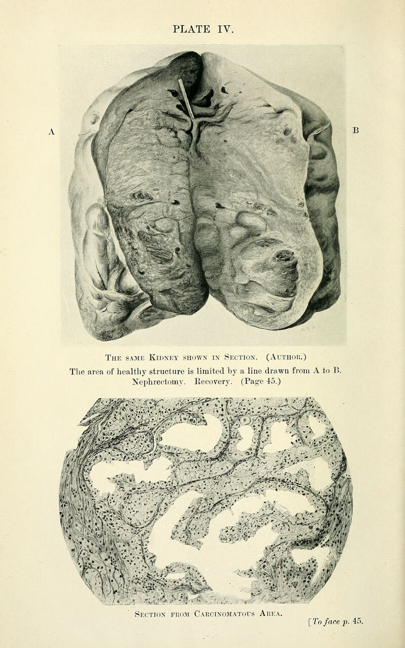 A The same Kidney shown in Section. (Author.) Tlie ai-ea of healthy structure is limited by a line drawn from A to B. Nephrectomv. Eecovery. (Page 45.) ^ffZ':/v.^ / ^-'^ '\r ./ • ^' - '' i; '^:!^' ;. .'^'^v- ' -. 1. Section fkom Carcinomatous Area.