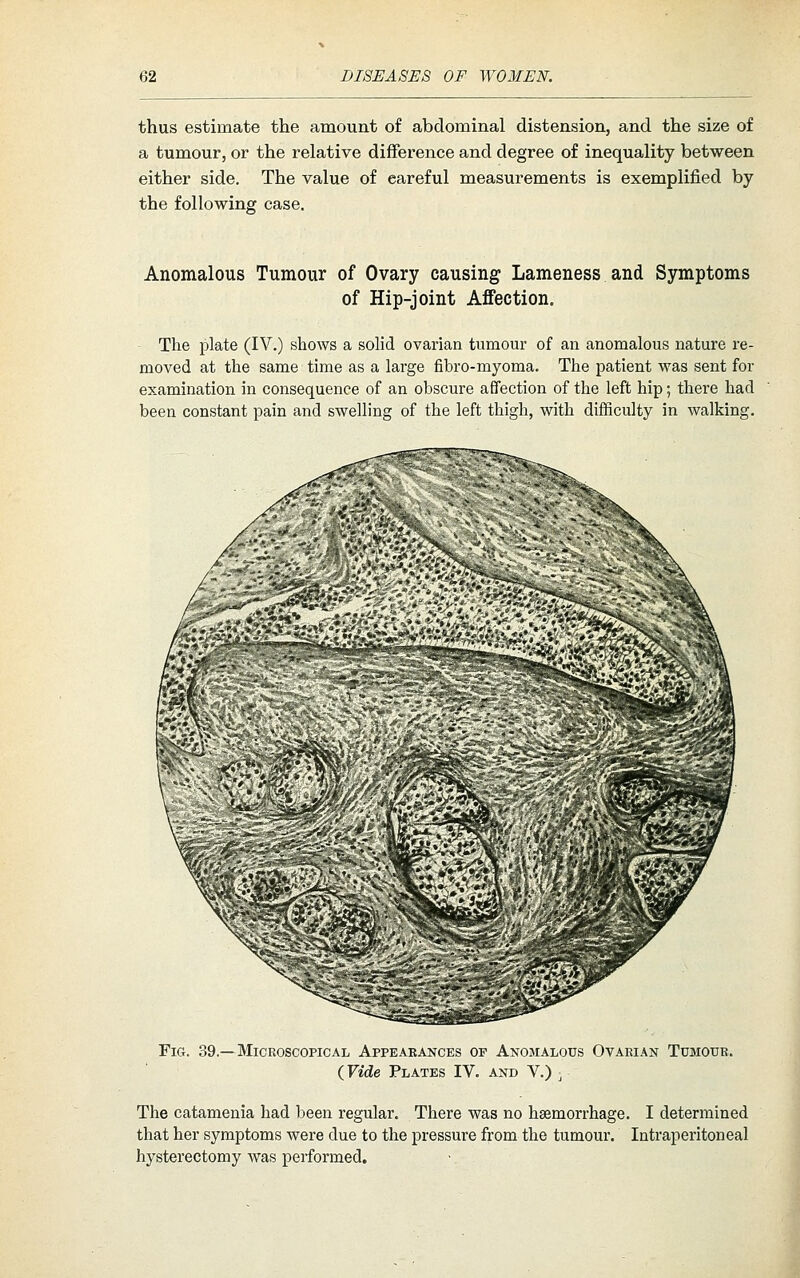 thus estimate the amount of abdominal distension, and the size of a tumour, or the relative difference and degree of inequality between either side. The value of careful measurements is exemplified by the following case. Anomalous Tumour of Ovary causing Lameness,and Symptoms of Hip-joint Affection. The plate (IV.) shows a solid ovarian tumour of an anomalous nature re- moved at the same time as a large fibro-myoma. The patient was sent for examination in consequence of an obscure affection of the left hip; there had been constant pain and swelling of the left thigh, with difficulty in walking. ^ ^^Ste. Fig. 39.—Microscopical Appearances of Anomalous Ovarian Tumour. (Vide Plates IV. and V.) ^ The catamenia had been regular. There was no haemorrhage. I determined that her symptoms were due to the pressure from the tumour. Intraperitoneal hysterectomy was performed.