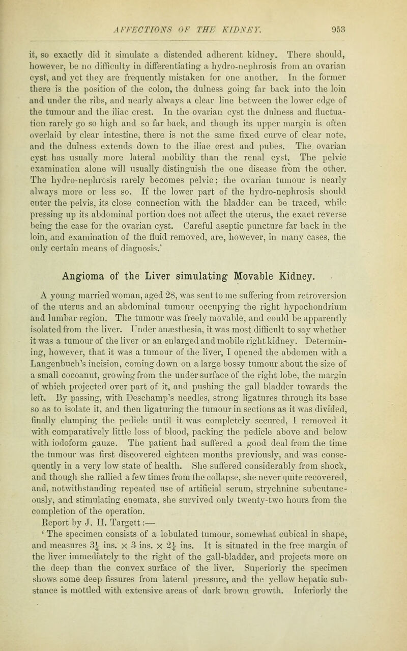 il., so exactly did it siinnlato a distended adlierent kidney. There should, however, be no difficulty in dilTeretitiating a hydro-nephrosis from an ovarian cyst, and yet they are frequently mistaken for one another. In the former there is the position of the colon, the dulness going far back into the loin and under the ribs, and nearly always a clear line between the lower edge of the tumour and the iliac crest. In the ovarian cj'^st the dulness and fluctua- ticu rarely go so high and so far back, and though its upper margin is often overlaid bj'' clear intestine, there is not the same fixed curve of clear note, and the dulness extends down to the iliac crest and pubes. The ovarian cyst has usuall} more lateral mobility than the renal cyst. The pelvic examination alone will usually distinguish the one disease from the other. The hydro-nephrosis rarely becomes pelvic; the ovarian tumour is nearly always more or less so. If the lower part of the hydro-nephrosis should enter the pelvis, its close connection with the bladder can be traced, while pressing up its abdominal portion does not affect the uterus, the exact reverse being the case for the ovarian cyst. Careful aseptic puncture far back in the loin, and examination of the fluid removed, are, however, in many cases, the only certain means of diagnosis.' Angioma of the Liver simulating Movable Kidney. A young married woman, aged 28, was sent to me suffering from retroversion of the uterus and an abdominal tumour occupying the right hypochondrium and lumbar region. The tumour was freely movable, and could be apparently isolated from the liver. Under anaesthesia, it was most difficult to say whether it was a tumour of the liver or an enlarged and mobile right kidney. Determin- ing, however, that it was a tumour of the liver, I opened the abdomen with a Langenbuch's incision, coming down on a large bossy tumour about the size of a small cocoanut, gTOwingfrom the under surface of the right lobe, the margin of which projected over part of it, and pushing the gall bladder towards the left. B}^ passing, with Deschamp's needles, strong ligatures through its base so as to isolate it, and then ligaturing the tumour in sections as it was divided, finalh' clamping the pedicle until it was completely secured, I removed it with comparatively little loss of blood, packing the pedicle above and below with iodoform gauze. The patient had suffered a good deal from the time the tumour was first discovered eighteen months previously, and was conse- quently in a very low state of health. She suffered considerably from shock, and though she rallied a few times from the collapse, she never quite recovered, and, notwithstanding repeated use of artificial serum, strychnine subcutane- ously, and stimulating enemata, she survived only twenty-two hours from the completion of the operation. Report by J. H. Targett :— ' The specimen consists of a lobulated tumour, somewhat cubical in shape, and measures 3^ ins. x 3 ins. x 2^ ins. It is situated in the free margin of the liver immediately to the right of the gall-bladder, and projects more on the deep than the convex surface of the liver. Superiorly the specimen shows some deep fissures from lateral pressure, and the yellow hepatic sub- stance is mottled with extensive areas of dark brown srrowth. Inferiorlv the