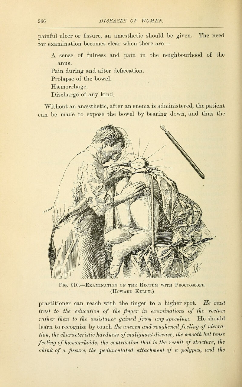 painful ulcer or fissure, an ansesthetic should be given. The need for examination becomes clear when there are— A sense of fulness and jDain in the neighbourhood of the anus. Pain during and after defsecation. Prolapse of the bowel. Haemorrhage. Discharge of any kind. Without an anesthetic, after an enema is administered, the patient can be made to expose the bowel by bearing down, and thus the Fig. 610.—Examination of the Eectum with Proctoscope. (Howard Kelly.) practitioner can reach with the finger to a higher spot. He must trust to the education of the finger in examinations of the rectum rather than to the assistance gained from any speculum. He should learn to recognize by touch the uneven and roughened feeling of ulcera- tion, the characteristic hardness of malignant disease, the smooth hut tense feeling of hsemorrhoids, the contraction that is the result of stricture, the chinJc of a fissure, the pedunculated attachment of a polypus, and the