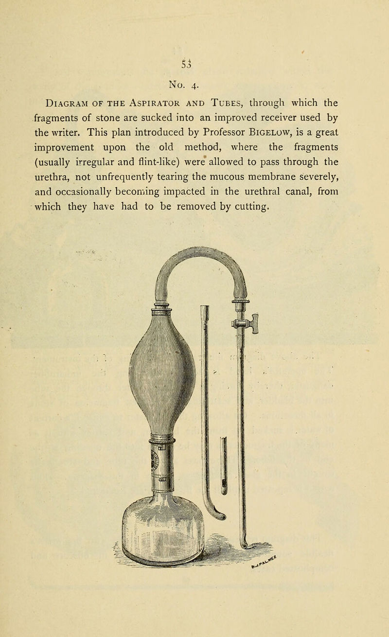 No. 4. Diagram of the Aspirator and Tubes, through which the fragments of stone are sucked into an improved receiver used by the writer. This plan introduced by Professor Bigelow, is a great improvement upon the old method, where the fragments (usually irregular and flint-like) were allowed to pass through the urethra, not unfrequently tearing the mucous membrane severely, and occasionally becoming impacted in the urethral canal, from which they have had to be removed by cutting.