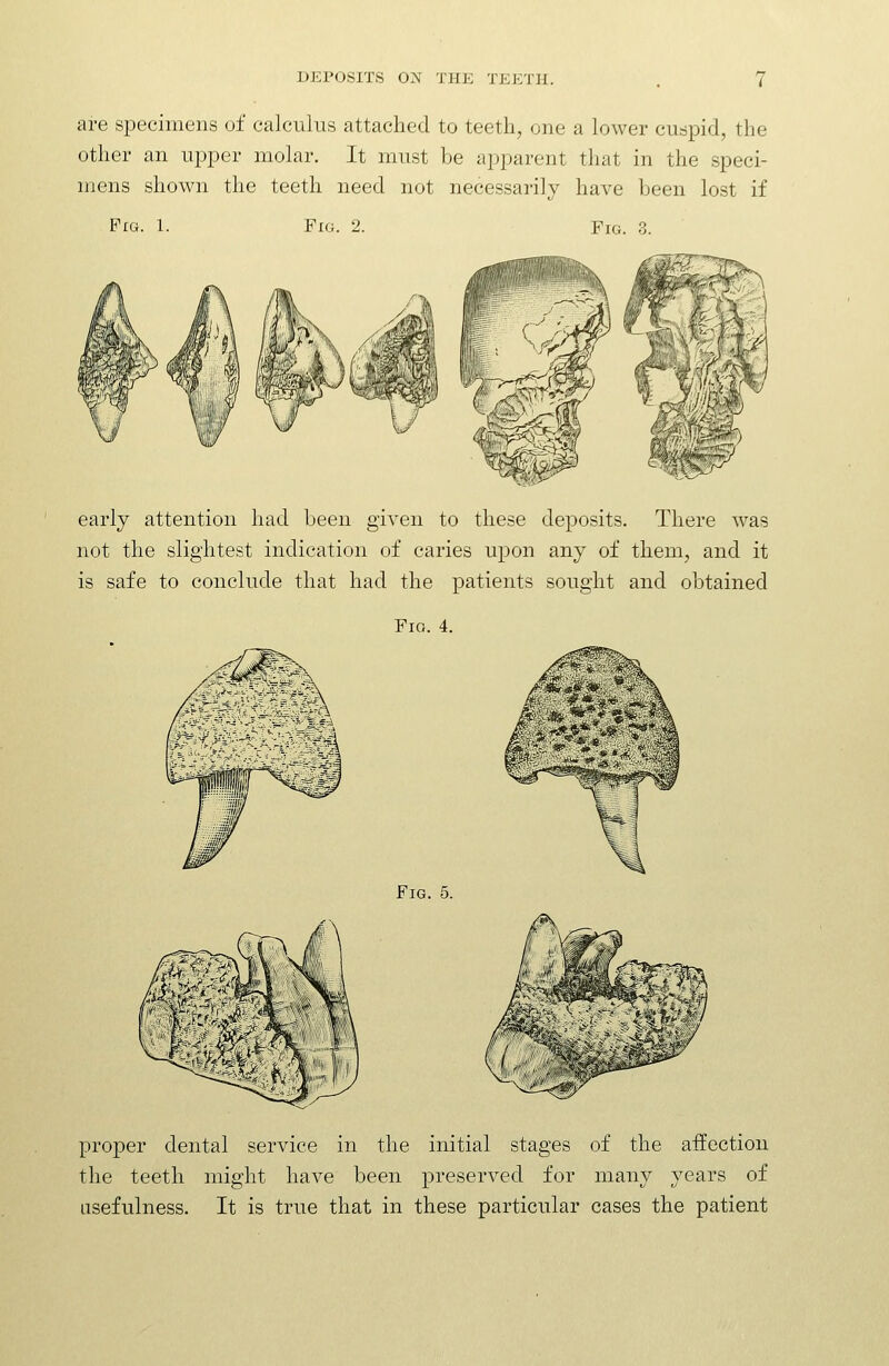 are specimens of calculus attached to teeth, one a lower cuspid, the other an upper molar. It must be apparent that in the speci- mens shown the teeth need not necessarily have been lost if Pig. 1. Fig. 2. Fig. 3. early attention had been given to these deposits. There was not the slightest indication of caries upon any of them, and it is safe to conclude that had the patients sought and obtained Fig. 4. Fig. 5. proper dental service in the initial stages of the affection the teeth might have been preserved for mam^ years of usefulness. It is true that in these particular cases the patient