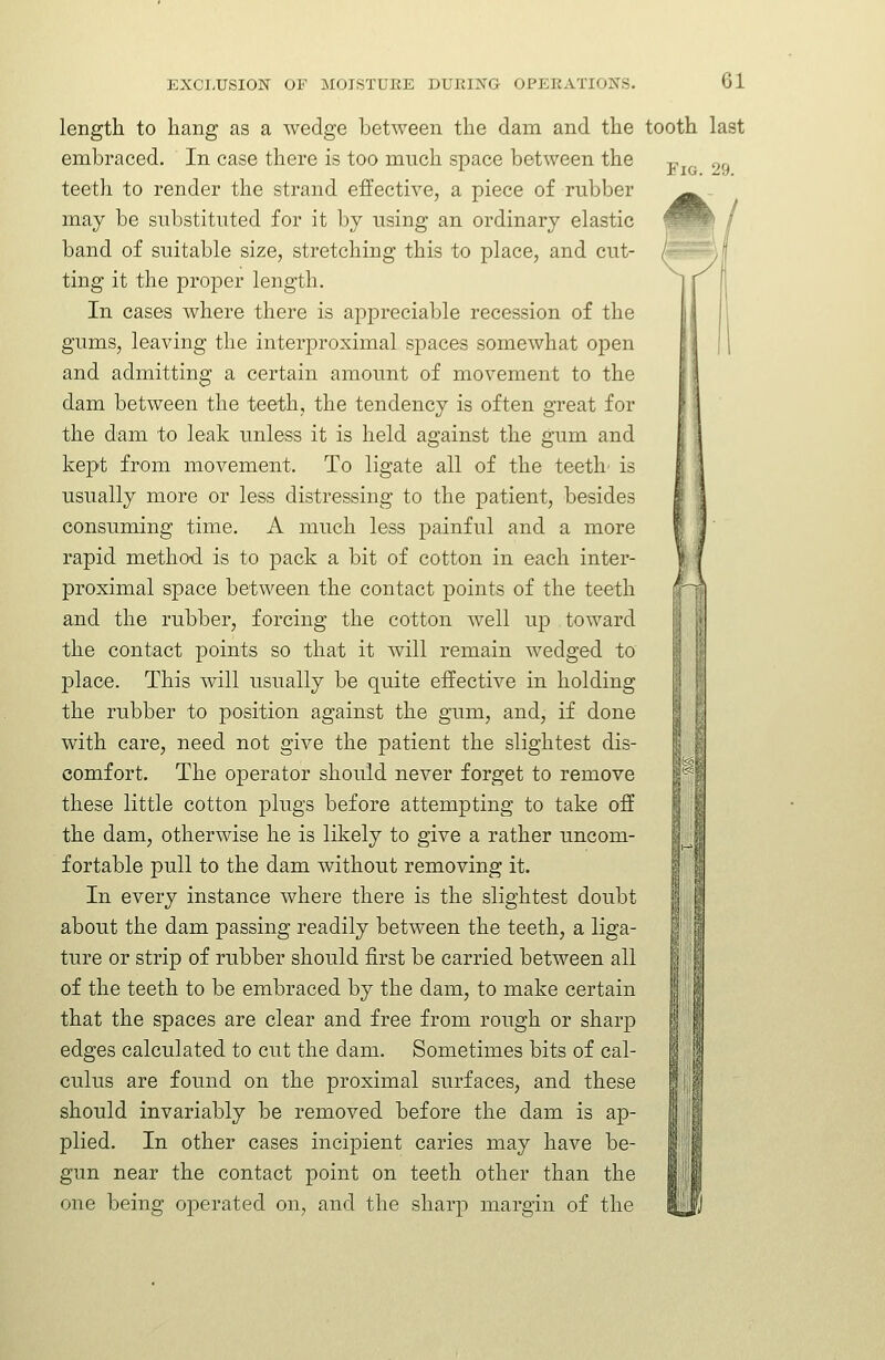 length to hang as a wedge between the dam and the embraced. In case there is too much space between the teeth to render the strand effective, a piece of rubber may be substituted for it by using an ordinary elastic band of suitable size, stretching this to place, and cut- ting it the proper length. In cases where there is appreciable recession of the gums, leaving the interproximal spaces somewhat open and admitting a certain amount of movement to the dam between the teeth, the tendency is often great for the dam to leak unless it is held against the gum and kept from movement. To ligate all of the teeth' is usually more or less distressing to the patient, besides consuming time. A much less painful and a more rapid method, is to pack a bit of cotton in each inter- proximal space between the contact points of the teeth and the rubber, forcing the cotton well up toward the contact points so that it will remain wedged to place. This will usually be quite effective in holding the rubber to position against the gum, and, if done with care, need not give the patient the slightest dis- comfort. The operator should never forget to remove these little cotton plugs before attempting to take off the dam, otherwise he is likely to give a rather uncom- fortable pull to the dam without removing it. In every instance where there is the slightest doubt about the dam passing readily between the teeth, a liga- ture or strip of rubber should first be carried between all of the teeth to be embraced by the dam, to make certain that the spaces are clear and free from rough or sharp edges calculated to cut the dam. Sometimes bits of cal- culus are found on the proximal surfaces, and these should invariably be removed before the dam is ap- plied. In other cases incipient caries may have be- gun near the contact point on teeth other than the one being operated on, and the sharp margin of the tooth Fig.