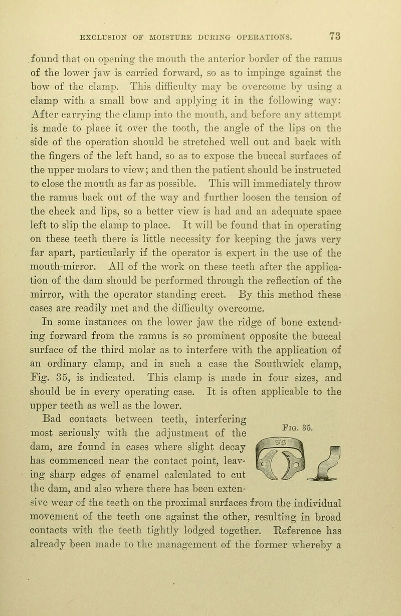 found that on opening the mouth the anterior Ijorder of the ramus of the lower jaw is carried forward, so as to impinge against the bow of the clamp. This difficulty may be overcome by using a clamp with a small bow and applying it in the following way: After carrying tlie clamp into the mouth, and before any attempt is made to place it over the tooth, the angle of the lips on the side of the oj^eration should be stretched well out and back with the fingers of the left hand, so as to expose the buccal surfaces of the upper molars to view; and then the patient should be instructed to close the mouth as far as possible. This will immediately throw the ramus back out of the way and further loosen the tension of the cheek and lips, so a better view is had and an adequate space left to slip the clamp to place. It will be found that in operating on these teeth there is little necessity for keeping the jaws very far apart, particularly if the operator is expert in the use of the mouth-mirror. All of the work on these teeth after the applica- tion of the dam should be performed through the reflection of the mirror, with the operator standing erect. By this method these cases are readily met and the difficulty overcome. In some instances on the lower jaw the ridge of bone extend- ing forward from the ramus is so prominent opposite the buccal surface of the third molar as to interfere with the application of an ordinary clamp, and in such a case the Southwick clamp, Fig. 35, is indicated. This clamp is made in four sizes, and should be in every operating case. It is often applicable to the upper teeth as well as the lower. Bad contacts between teeth, interfering most seriously with the adjustment of the dam, are found in cases where slight decay lli^, ._ --il m has commenced near the contact point, leav- fp/ Idi /^J ing sharp edges of enamel calculated to cut \4i A.^^ j^ the dam, and also wdiere there has been exten- sive wear of the teeth on the proximal surfaces from the individual movement of the teeth one against the other, resulting in broad contacts with the teeth tightly lodged together. Reference has already been made to the management of the former whereby a