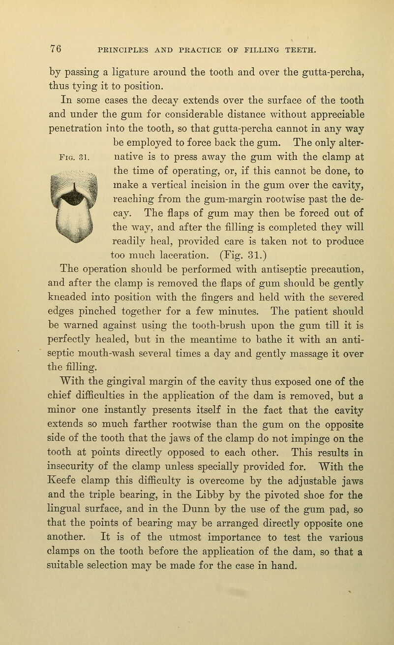 by passing a ligature around the tooth and over the gutta-percha, thus tying it to position. In some cases the decay extends over the surface of the tooth and under the gum for considerable distance without appreciable penetration into the tooth, so that gutta-percha cannot in any way be employed to force back the gum. The only alter- FiG. 31. native is to press away the gum with the clamp at the time of operating, or, if this cannot be done, to make a vertical incision in the gum over the cavity, reaching from the gum-margin rootwise past the de- cay. The flaps of gum may then be forced out of the way, and after the filling is completed they will readily heal, provided care is taken not to produce too much laceration. (Fig. 31.) The operation should be performed with antiseptic precaution, and after the clamp is removed the flaps of gum should be gently kneaded into position vsdth the fingers and held with the severed edges pinched together for a few minutes. The patient should be warned against using the tooth-brush upon the gum till it is perfectly healed, but in the meantime to bathe it with an anti- septic mouth-wash several times a day and gently massage it over the filling. With the gingival margin of the cavity thus exposed one of the chief diflSculties in the application of the dam is removed, but a minor one instantly presents itself in the fact that the cavity extends so much farther rootwise than the gum on the opposite side of the tooth that the jaws of the clamp do not impinge on the tooth at points directly opposed to each other. This results in insecurity of the clamp unless specially provided for. With the Keefe clamp this difficulty is overcome by the adjustable jaws and the triple bearing, in the Libby by the pivoted shoe for the lingual surface, and in the Dunn by the use of the gum pad, so that the points of bearing may be arranged directly opposite one another. It is of the utmost importance to test the various clamps on the tooth before the application of the dam, so that a suitable selection may be made for the case in hand.