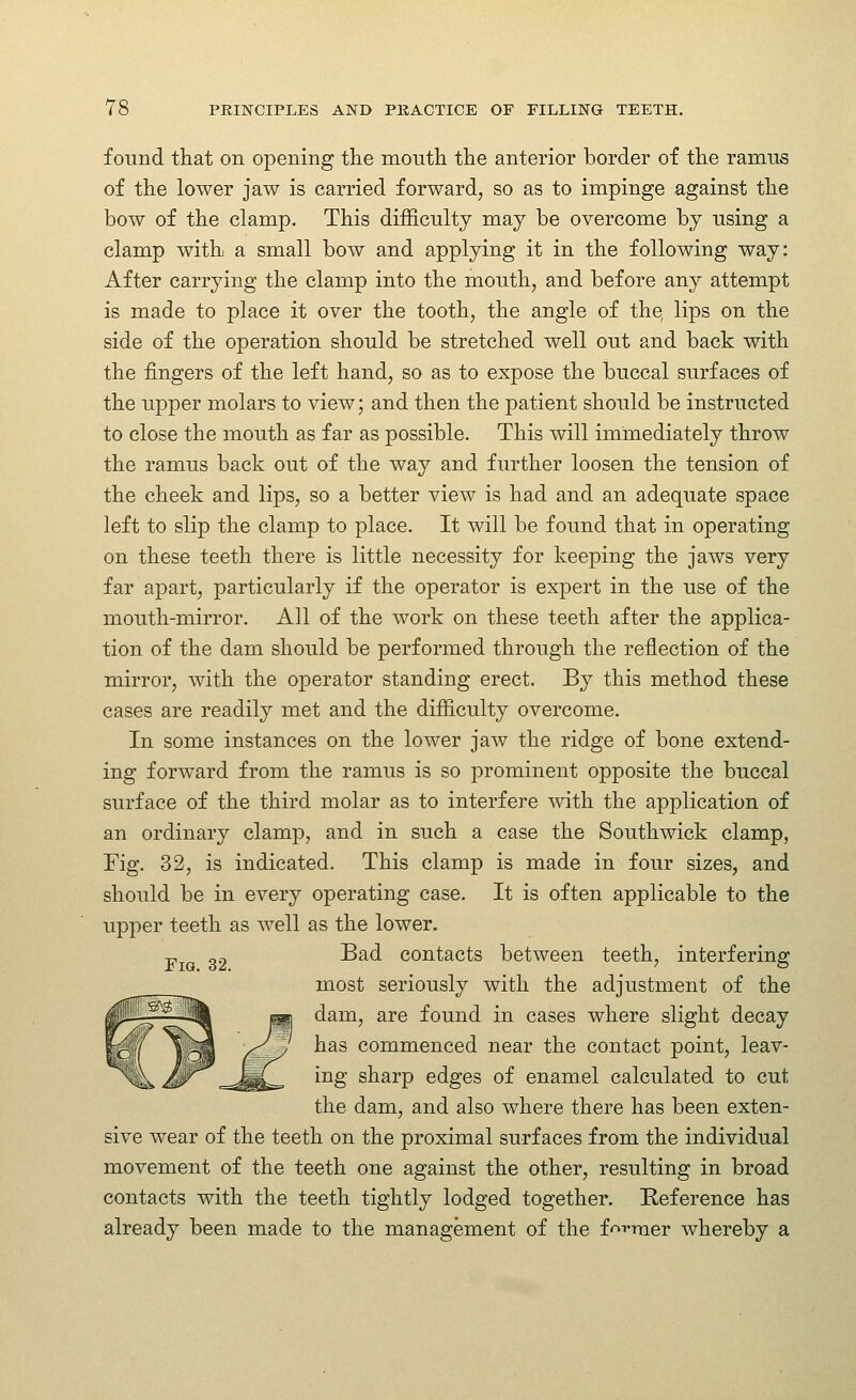 found that on opening the mouth the anterior border of the ramus of the lower jaw is carried forward, so as to impinge against the bow of the clamp. This difficulty may be overcome by using a clamp with a small bow and applying it in the following way: After carrying the clamp into the mouth, and before any attempt is made to place it over the tooth, the angle of the, lips on the side of the operation should be stretched well out and back with the fingers of the left hand, so as to expose the buccal surfaces of the upper molars to view; and then the patient should be instructed to close the mouth as far as possible. This will immediately throw the ramus back out of the way and further loosen the tension of the cheek and lips, so a better view is had and an adequate space left to slip the clamp to place. It will be found that in operating on these teeth there is little necessity for keeping the jaws very far apart, particularly if the operator is expert in the use of the mouth-mirror. All of the work on these teeth after the applica- tion of the dam should be performed through the reflection of the mirror, with the operator standing erect. By this method these cases are readily met and the difficulty overcome. In some instances on the lower jaw the ridge of bone extend- ing forward from the ramus is so prominent opposite the buccal surface of the third molar as to interfere with the application of an ordinary clamp, and in such a case the Southwick clamp, Fig. 32, is indicated. This clamp is made in four sizes, and should be in every operating case. It is often applicable to the upper teeth as well as the lower. -p „2 -Bad contacts between teeth, interfering most seriously with the adjustment of the JP' '-^llM mi dam, are found in cases where slight decay iPlf loi /^5^ ^^^ commenced near the contact point, leav- 1%, ^^ =s^^ ^^S sharp edges of enamel calculated to cut the dam, and also where there has been exten- sive wear of the teeth on the proximal surfaces from the individual movement of the teeth one against the other, resulting in broad contacts with the teeth tightly lodged together. Reference has already been made to the management of the f'^i-mer Avhereby a