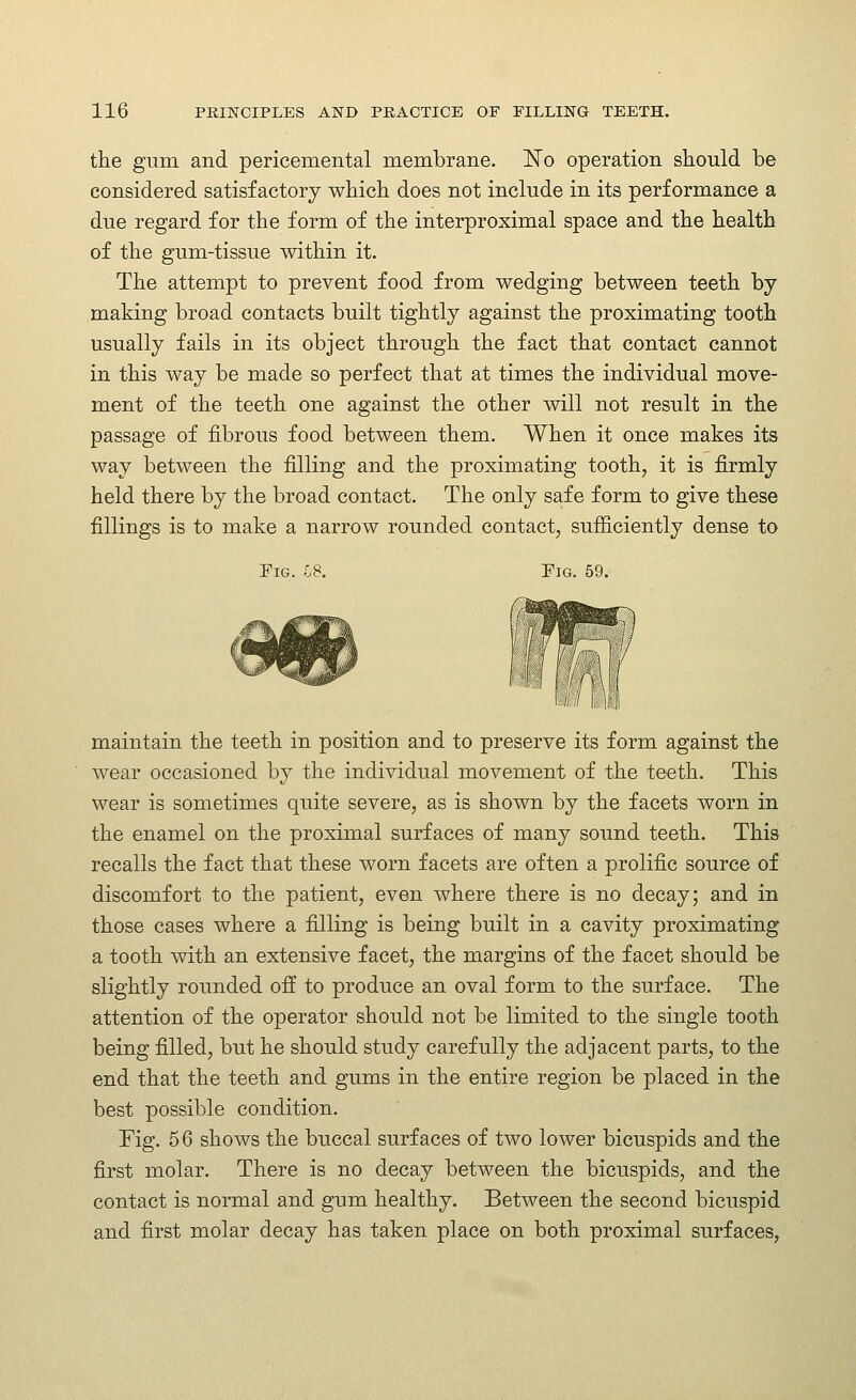 the gum and pericemental membrane. ]^o operation should be considered satisfactory which does not include in its performance a due regard for the form of the interproximal space and the health of the gum-tissue within it. The attempt to prevent food from wedging between teeth by making broad contacts built tightly against the proximating tooth usually fails in its object through the fact that contact cannot in this way be made so perfect that at times the individual move- ment of the teeth one against the other will not result in the passage of fibrous food between them. When it once makes its way between the filling and the proximating tooth, it is firmly held there by the broad contact. The only safe form to give these fillings is to make a narrow rounded contact, sufiiciently dense to Pig. i8. Fig. 59. maintain the teeth in position and to preserve its form against the wear occasioned by the individual movement of the teeth. This wear is sometimes quite severe, as is shown by the facets worn in the enamel on the proximal surfaces of many sound teeth. This recalls the fact that these worn facets are often a prolific source of discomfort to the patient, even where there is no decay; and in those cases where a filling is being built in a cavity proximating a tooth with an extensive facet, the margins of the facet should be slightly rounded off to produce an oval form to the surface. The attention of the operator should not be limited to the single tooth being filled, but he should study carefully the adjacent parts, to the end that the teeth and gums in the entire region be placed in the best possible condition. Fig. 56 shows the buccal surfaces of two lower bicuspids and the first molar. There is no decay between the bicuspids, and the contact is normal and gum healthy. Between the second bicuspid and first molar decay has taken place on both proximal surfaces,