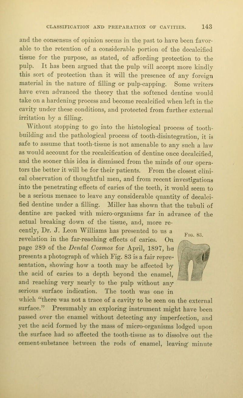 and the consensus of opinion seems in the past to have been favor- able to the retention of a considerable portion of the decalcified tissue for the purpose, as stated, of affording protection to the pulp. It has been argued that the pulp will accept more kindly this sort of protection than it will the presence of any foreign material in the nature of filling or pulp-capping. Some writer.'? have even advanced the theory that the softened dentine would take on a hardening process and become recalcified when left in the cavity under these conditions, and protected from further external irritation by a filling. Without stopping to go into the histological process of tooth- building and the pathological process of tooth-disintegration, it is safe to assume that tooth-tissue is not amenable to any such a law as would account for the recalcification of dentine once decalcified, and the sooner this idea is dismissed from the minds of our opera- tors the better it will be for their patients. From the closest clini- cal observation of thoughtful men, and from recent investigations into the penetrating effects of caries of the teeth, it would seem to be a serious menace to leave any considerable quantity of decalci- fied dentine under a filling. Miller has shown that the tubuli of dentine are packed with micro-organisms far in advance of the actual breaking down of the tissue, and, more re- cently. Dr. J. Leon Williams has presented to us a revelation in the far-reaching effects of caries. On .- page 289 of the Dental Cosmos for April, 1897, ha I - ZW\^ presents a photograph of which Fig. 83 is a fair repre- j sentation, showing how a tooth may be affected by y the acid of caries to a depth beyond the enamel, A and reaching very nearly to the pulp without any serious surface indication. The tooth was one in which there was not a trace of a cavity to be seen on the external surface. Presumably an exploring instrument might have been passed over the enamel without detecting any imperfection, and yet the acid formed by the mass of micro-organisms lodged upon the surface had so affected the tooth-tissue as to dissolve out the cement-substance between the rods of enamel, leaving minute