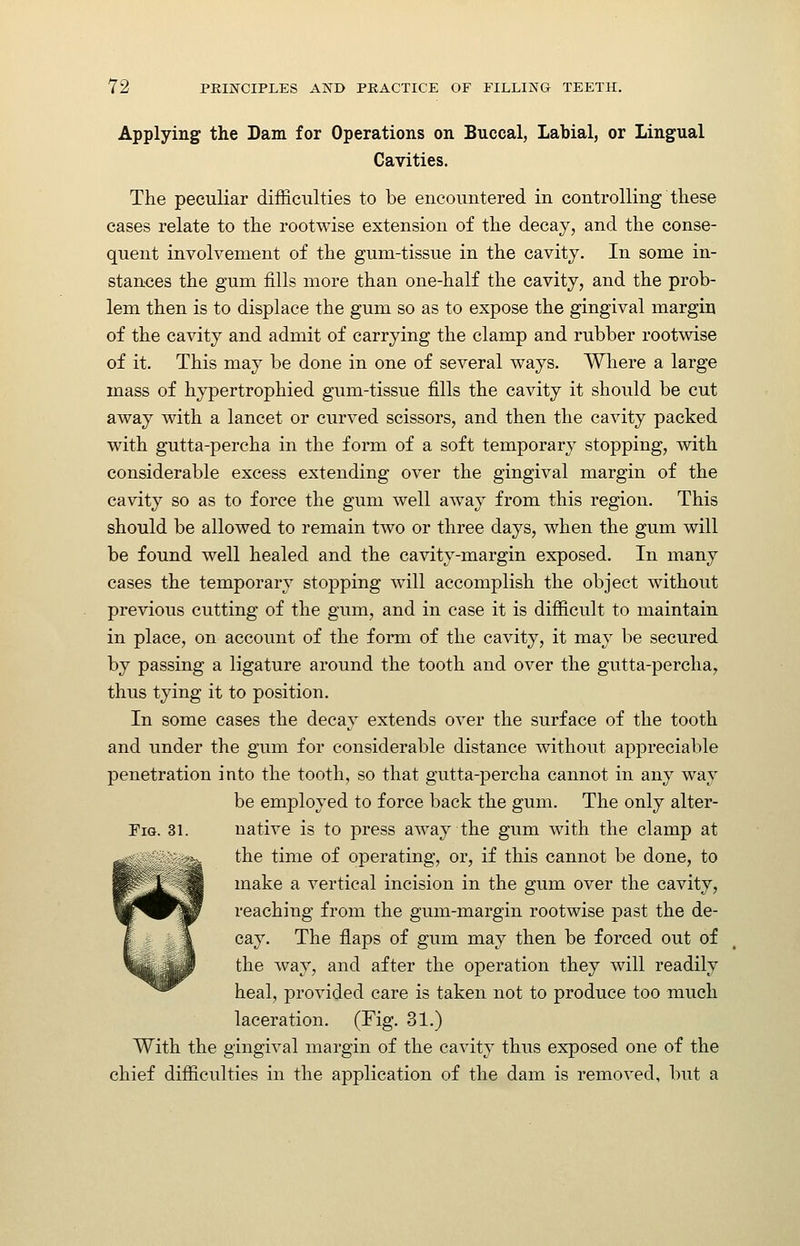 Applying the Dam for Operations on Buccal, Labial, or Lingual Cavities. The pecuKar difficulties to be encountered in controlling these cases relate to the rootwise extension of the decay, and the conse- quent involvement of the gum-tissue in the cavity. In some in- stan-ces the gum fills more than one-half the cavity, and the prob- lem then is to displace the gum so as to expose the gingival margin of the cavity and admit of carrying the clamp and rubber rootwise of it. This may be done in one of several ways. Wliere a large mass of hypertrophied gum-tissue fills the cavity it should be cut away with a lancet or curved scissors, and then the cavity packed with gutta-percha in the form of a soft temporary stopping, with considerable excess extending over the gingival margin of the cavity so as to force the gum well away from this region. This should be allowed to remain two or three days, when the gum will be found well healed and the cavity-margin exposed. In many cases the temporary stopping will accomplish the object without previous cutting of the gum, and in case it is difficult to maintain in place, on account of the form of the cavity, it may be secured by passing a ligature around the tooth and over the gutta-percha, thus tying it to position. In some cases the decay extends over the surface of the tooth and under the gum for considerable distance without appreciable penetration into the tooth, so that gutta-percha cannot in any way be employed to force back the gum. The only alter- FiG. 31. native is to press away the gum with the clamp at the time of operating, or, if this cannot be done, to make a vertical incision in the gum over the cavity, reaching from the gum-margin rootwise past the de- cay. The flaps of gum may then be forced out of the way, and after the operation they will readily heal, provided care is taken not to produce too much laceration. (Fig. 31.) With the gingival margin of the cavity thus exposed one of the chief difficulties in the application of the dain is removed, but a