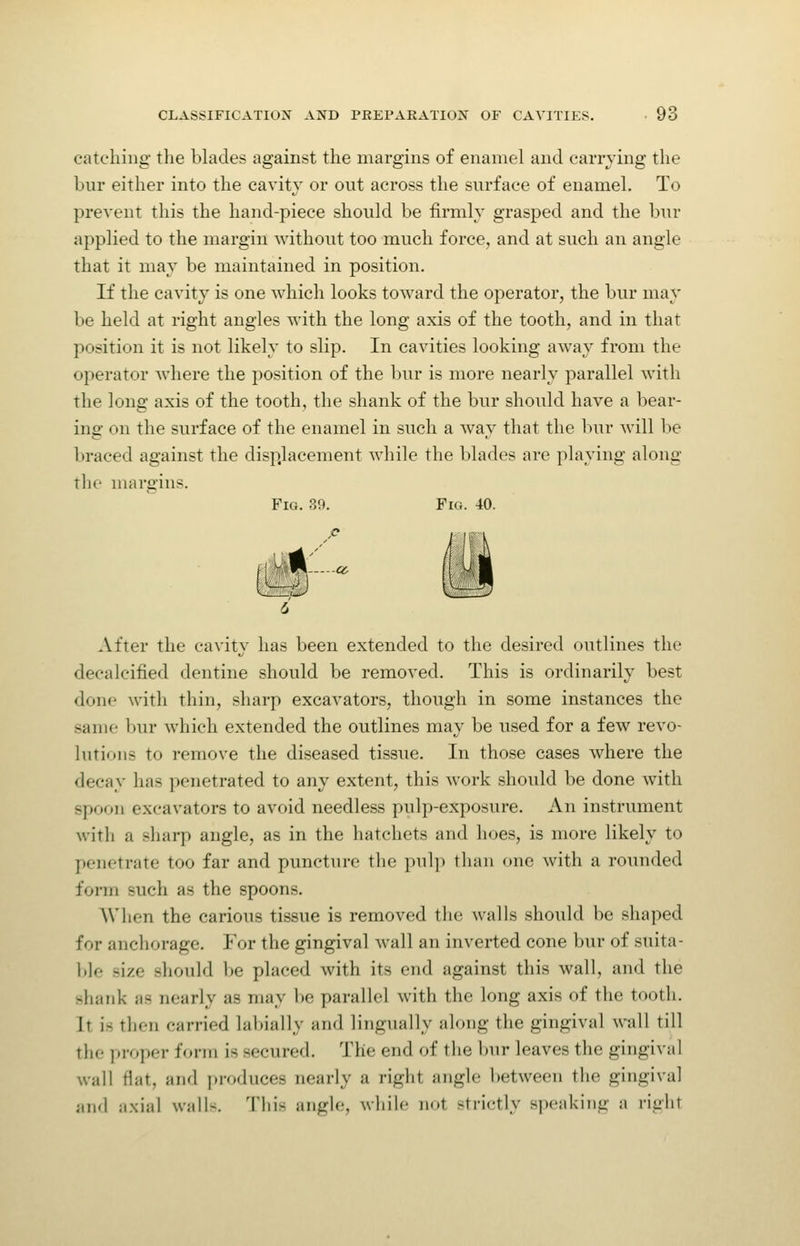 catching the blades against the margins of enamel and carrying the bur either into the cavity or out across the surface of enamel. To prevent this the hand-piece should be firmly grasped and the bur applied to the margin without too much force, and at such an angle that it may be maintained in position. If the cavity is one which looks toward the operator, the bur may be held at right angles with the long axis of the tooth, and in that position it is not likely to slip. In cavities looking away from the operator where the position of the bur is more nearly parallel with the long axis of the tooth, the shank of the bur should have a bear- ing on the surface of the enamel in such a way that the l)ur will be braced against the displacement while the blades are playing along the margins. Fig. 39. Fig. 40. ,o i After the cavity has been extended to the desired outlines the decalcified dentine should be removed. This is ordinarily best done with thin, sharp excavators, though in some instances the same bur which extended the outlines may be used for a few revo- lutions to remove the diseased tissue. In those cases where the decay has penetrated to any extent, this work should be done with spoon excavators to avoid needless pulp-exposure. An instrument with a sharp angle, as in the hatchets and hoes, is more likely to penetrate too far and puncture the pulp than one with a rounded form such as the spoons. AVhen the carious tissue is removed the walls should be shaped for anchorage. For the gingival wall an inverted cone bur of suita- l)]e size should be placed with its end against this wall, and the shank as nearly as may be parallel with the long axis of the tooth. It is then carried labially and lingually along the gingival -vvall till the pi-oper form is secured. The end of the l)ur leaves the gingival wall flat, and produces nearly a right angle between the gingival and ii.xial walls. T\m angle, while not strictly speaking a right