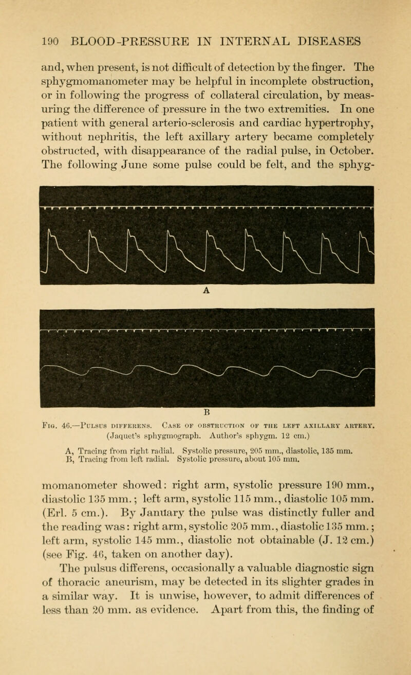 and, when present, is not difficult of detection by the finger. The sphygmomanometer may be helpful in incomplete obstruction, or in following the progress of collateral circulation, by meas- uring the difference of pressure in the two extremities. In one patient with general arterio-sclerosis and cardiac hypertrophy, without nephritis, the left axillary artery became completely obstructed, with disappearance of the radial pulse, in October. The following June some pulse could be felt, and the sphyg- P^io. 46.—Pulsus differens. Case of obstkuction of the left axillary artery. (Jaquet's sphygmograph. Author's sphygm. 12 cm.) A, Tracing from right radial. Systolic pressure, 205 mm., diastolic, 135 mm. B, Tracing from left radial. Systolic pressure, about 105 mm. momanometer showed: right arm, systolic pressure 190 mm., diastolic 135 mm.; left arm, sj^stolic 115 mm., diastolic 105 mm. (Erl. 5 cm.). By January the pulse was distinctly fuller and the reading was: right arm, systolic 205 mm., diastolic 135 mm.; left arm, systolic 145 mm., diastolic not obtainable (J. 12 cm.) (see Fig. 4(5, taken on another day). The pulsus differens, occasionally a valuable diagnostic sign of thoracic aneurism, may be detected in its slighter grades in a similar way. It is unwise, however, to admit differences of less than 20 mm. as evidence. Apart from this, the finding of