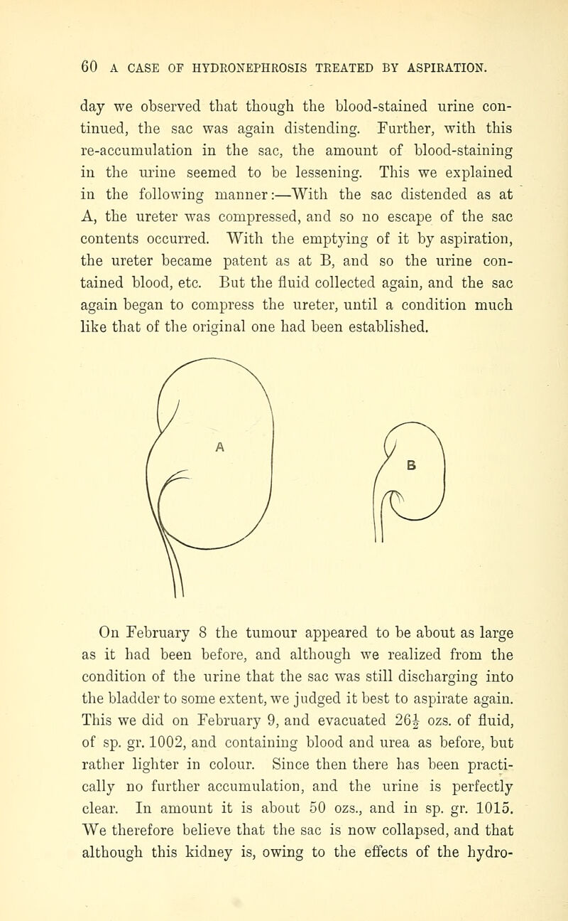 day we observed that though the blood-stained urine con- tinued, the sac was again distending. Further, with this re-accumulation in the sac, the amount of blood-staining in the urine seemed to be lessening. This we explained in the following manner:—With the sac distended as at A, the ureter was compressed, and so no escape of the sac contents occurred. With the emptying of it by aspiration, the ureter became patent as at B, and so the urine con- tained blood, etc. But the fluid collected again, and the sac again began to compress the ureter, until a condition much like that of the original one had been established. On February 8 the tumour appeared to be about as large as it had been before, and although we realized from the condition of the urine that the sac was still discharging into the bladder to some extent, we judged it best to aspirate again. This we did on February 9, and evacuated 26| ozs. of fluid, of sp. gr. 1002, and containing blood and urea as before, but rather lighter in colour. Since then there has been practi- cally no further accumulation, and the urine is perfectly clear. In amount it is about 50 ozs., and in sp. gr. 1015. We therefore believe that the sac is now collapsed, and that although this kidney is, owing to the effects of the hydro-