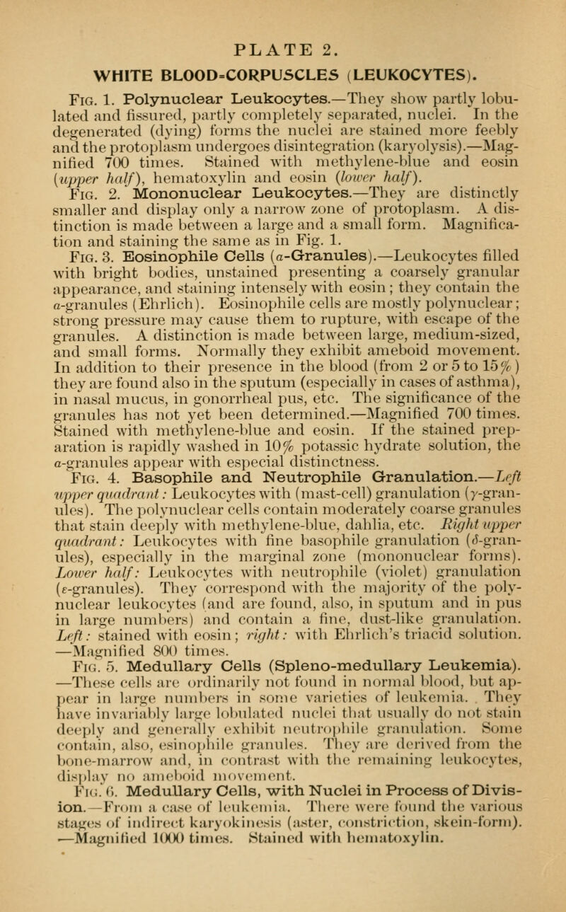 WHITE BLOOD=CORPUSCLES (LEUKOCYTES). Fig. 1. Polynuclear Leukocytes.—They show partly lobu- lated and fissured, partly completely separated, nuclei. In the degenerated (dying) forms the nuclei are stained more feebly and the protoplasm undergoes disintegration (karyolysis).—Mag- nified 700 times. Stained with methylene-blue and eosin [upper half), hematoxylin and eosin {lower half). Fig. 2. Mononuclear Leukocytes.—They are distinctly smaller and display only a narrow zone of protoplasm. A dis- tinction is made between a large and a small form. Magnifica- tion and staining the same as in Fig. 1. Fig. 3. Eosinopliile Cells (a-Granules).—Leukocytes filled with bright bodies, unstained presenting a coarsely granular appearance, and staining intensely with eosin ; they contain the a-granules (Ehrlich). Eosinophile cells are mostly polynuclear; strong pressure may cause them to rupture, with escape of the granules. A distinction is made between large, medium-sized, and small forms. Normally they exhibit ameboid movement. In addition to their presence in the blood (from 2 or 5 to 15% ) they are found also in the sputum (especially in cases of asthma), in nasal mucus, in gonorrheal pus, etc. The significance of the granules has not yet been determined.—Magnified 700 times. Stained with methylene-blue and eosin. If the stained prep- aration is rapidly washed in 10% potassic hydrate solution, the a-granules appear with especial distinctness. Fig. 4. Basophile and Neutrophile Granulation.—Left upper quadrant: Leukocytes with (mast-cell) granulation (y-gran- ules). The polynuclear cells contain moderately coarse granules that stain deeply with methylene-blue, dahlia, etc. Right upper quadrant: Leukocytes with fine basophile granulation ((5-gran- ules), especially in the marginal zone (mononuclear forms). Loiver half: Leukocytes with neutrophile (violet) granulation (f-granules). They correspond with the majority of the poly- nuclear leukocytes (and are found, also, in sputum and in pus in large numbers) and contain a fine, dust-like granulation. Left: stained with eosin; right: with Ehrlich's triacid solution. —Magnified 800 times. Fig. 5. Medullary Cells (Spleno-medullary Leukemia). —These cells are ordinarily not found in normal blood, but ap- pear in large numl)ers in some varieties of leukemia. They have invariably large lobulated nuclei that usually do not stain deeply and generally exhil)it neutrophile granulation. Some contain, also, esinoj)hile granules. They are derived from the bone-marrow and, in contrast with the remaining leukocytes, disi)lay nf) ameboid movement. Fig. C). Medullary Cells, -with Nuclei in Process of Divis- ion.—From a case of leukemia. There were found the various stages of inchreet karyokinesis (a.ster, constriction, skein-form). •—Magnilied UXX) times. Stained with hematoxylin.