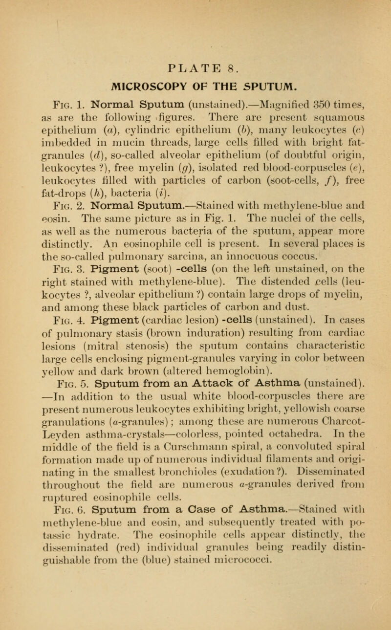 MICROSCOPY OF THE SPUTUM. Fig. 1. Normal Sputum (unstained).—Magnified 350 times, as are the following figures. There are present squamous epithelium (a), cylindric epithelium (6), many leukocytes (c) imhedded in mucin threads, large cells filled with bright fat- granules [d), so-called alveolar epithelium (of doubtful origin, leukocytes ?), free myelin (g), isolated red blood-corpuscles (e), leukocytes filled with particles of carbon (soot-cells, /), free fot-drops (/?), bacteria (i). Fig. 2. Normal Sputum.—Stained with methylene-blue and eosin. The same picture as in Fig. 1. The nuclei of the cells, as w^ell as the numerous bacteria of the si^utum, appear more distinctly. An eosinophile cell is present. In several places is the so-called pulmonary sarcina, an innocuous coccus. Fig. 3. Pigment (soot) -cells (on the left unstained, on the right stained with methylene-blue). The distended cells (leu- kocytes ?, alveolar epithelium ?) contain large drops of myelin, and among these black particles of carbon and dust. Fig. 4. Pigment (cardiac lesion) -cells (unstained). In cases of pulmonary stasis (brown induration) resulting from cardiac lesions (mitral stenosis) the sputum contains characteristic large cells enclosing pigment-graiuiles varying in color between yellow and dark brown (altered hemogk)l)in). Fig. 5. Sputum from an Attack of Asthma (unstained). —In addition to the usual white blood-corpuscles there are present numerous leukocytes exhibiting bright, yellowish coarse granulations (a-granules); among these are numerous Charcot- Leyden asthma-crystals—colorless, pointed octahedra. In the middle of the field is a Curschmann si)iral, a convoluted spiral formation made up of numerous individual filaments and origi- nating in the smallest bronchioles (exudation?). Disseminated throughout the field are numerous a-granules derived from ruptured eosinophile cells. Fig. C. Sputum from a Case of Asthma.—Stained with methylene-l)lue and eosin, and subsecjuently treated with po- tassic hydrate. The eosinophile cells aj)j)ear distinctly, the disseminated (red) individual granules being readily distin- guishable from the (blue) stained micrococci.