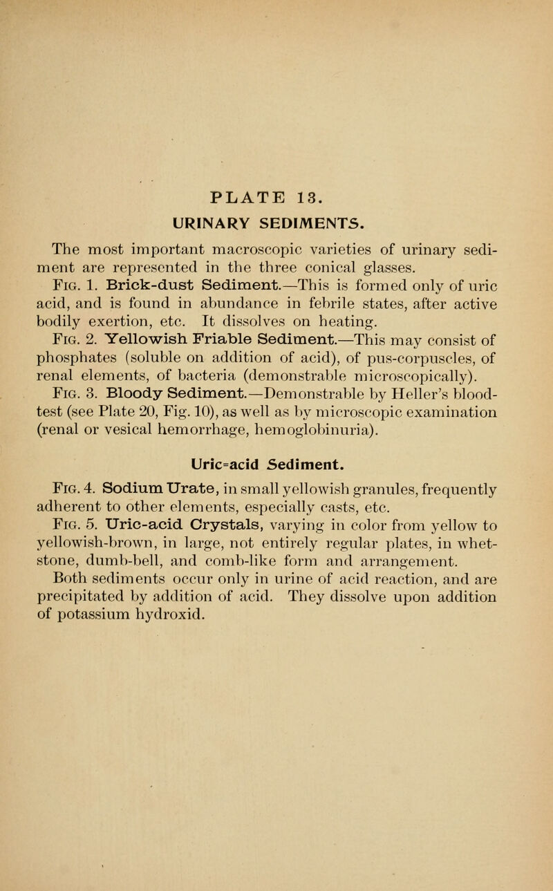 URINARY SEDIMENTS. The most important macroscopic varieties of urinary sedi- ment are represented in the three conical glasses. Fig. 1. Brick-dust Sediment.—This is formed only of uric acid, and is found in abundance in febrile states, after active bodily exertion, etc. It dissolves on heating. Fig. 2. Yellowish Friable Sediment.—This may consist of phosphates (soluble on addition of acid), of pus-corpuscles, of renal elements, of bacteria (demonstrable microscopically). Fig. 3. Bloody Sediment.—Demonstrable by Heller's blood- test (see Plate 20, Fig. 10), as well as by microscopic examination (renal or vesical hemorrhage, hemoglobinuria). Uric=acid Sediment. Fig. 4. Sodium Urate, in small yellowish granules, frequently adherent to other elements, especially casts, etc. Fig. 5. Uric-acid Crystals, varying in color from yellow to yellowish-brown, in large, not entirely regular plates, in whet- stone, dumb-bell, and comb-like form and arrangement. Both sediments occur only in urine of acid reaction, and are precipitated by addition of acid. They dissolve upon addition of potassium hydroxid.