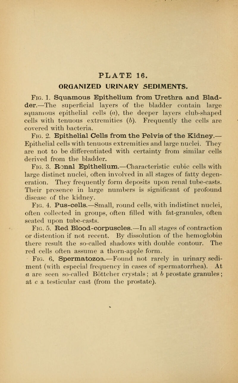 ORGANIZED URINARY SEDIMENTS. Fig. 1. Squamous Epithelium from Urethra and Blad- der.—The superficial layers of the bladder contain large squamous epithelial cells («), the deeper layers club-shaped cells with tenuous extremities (b). Frequently the cells are covered with bacteria. Fig. 2. Epithelial Cells from the Pelvis of the Kidney.— Epithelial cells with tenuous extremities and large nuclei. They are not to be differentiated with certainty from similar cells derived from the bladder. Fig. 3. Ronal Epithelium.—Characteristic cubic cells with large distinct nuclei, often involved in all stages of fatty degen- eration. They frequently form deposits upon renal tube-casts. Their presence in large numbers is significant of profound disease of the kidney. Fig. 4. Pus-cells.—Small, round cells, with indistinct nuclei, often collected in groups, often filled with fat-granules, often seated upon tube-casts. Fig. 5. Red Blood-corpuscles.—In all stages of contraction or distention if not recent. By dissolution of the hemoglobin there result the so-called shadows with double contour. The red cells often assume a thorn-apple form. Fig. 6. Spermatozoa.—Found not rarely in urinary sedi- ment (with especial fi-e(iuency in cases of spermatorrhea). At a are seen so-called Bottcher crystals; at b prostate granules; at c a testicular cast (from the prostate).