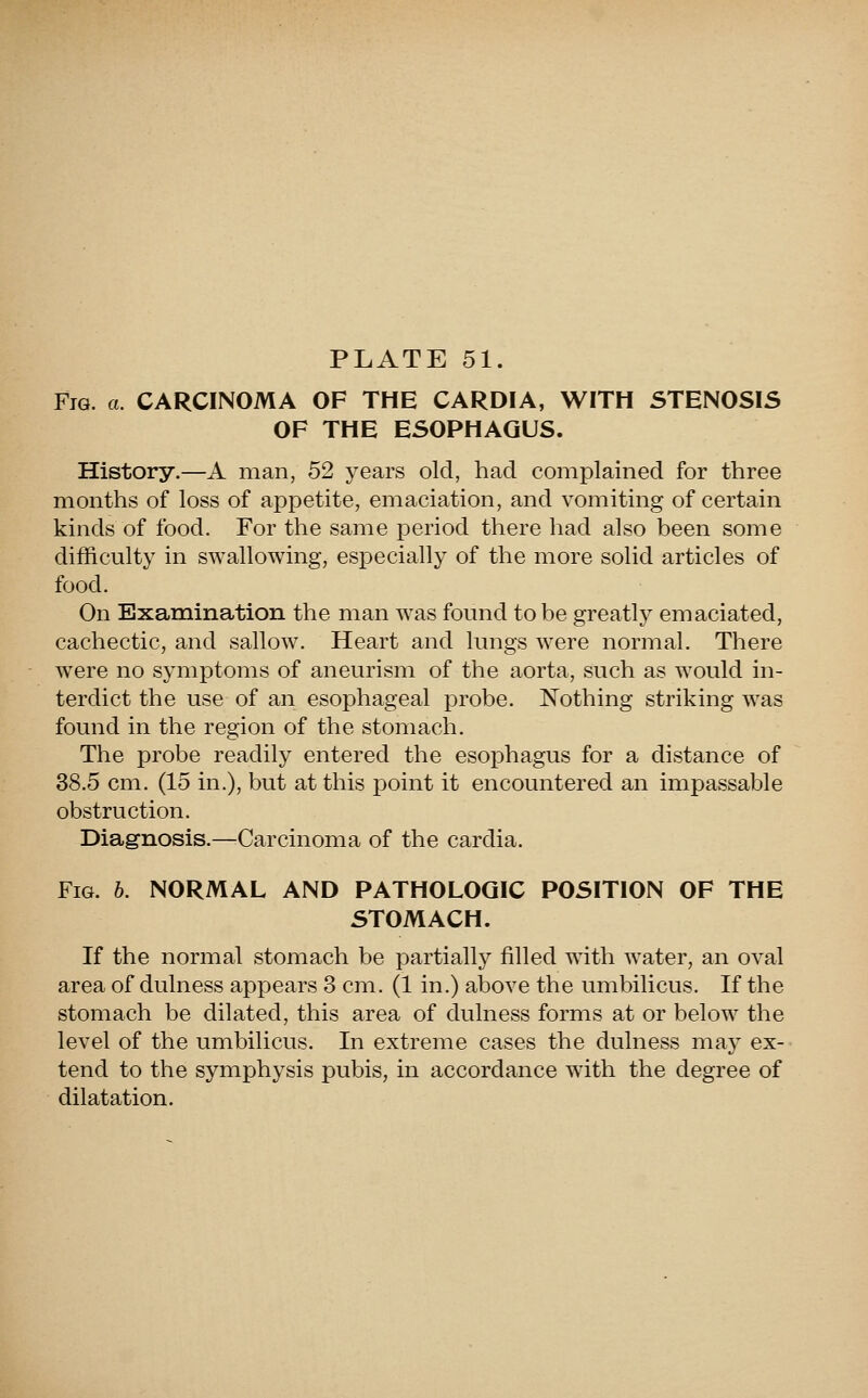 Fig. a. CARCINOMA OF THE CARDIA, WITH STENOSIS OF THE ESOPHAGUS. History.—A man, 52 years old, had complained for three months of loss of appetite, emaciation, and vomiting of certain kinds of food. For the same period there had also been some difficulty in swallowing, especially of the more solid articles of food. On Examination the man was found to be greatly emaciated, cachectic, and sallow. Heart and lungs were normal. There were no symptoms of aneurism of the aorta, such as would in- terdict the use of an esophageal probe. Nothing striking was found in the region of the stomach. The probe readily entered the esophagus for a distance of 38.5 cm. (15 in.), but at this point it encountered an impassable obstruction. Diagnosis.—Carcinoma of the cardia. Fig. 6. NORMAL AND PATHOLOGIC POSITION OF THE STOMACH. If the normal stomach be partially filled with water, an oval area of dulness appears 3 cm. (1 in.) above the umbilicus. If the stomach be dilated, this area of dulness forms at or below the level of the umbilicus. In extreme cases the dulness may ex- tend to the symphysis pubis, in accordance with the degree of dilatation.