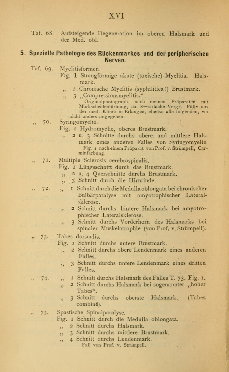 Taf. 6S. Aufsteigende Degeneration ini oberen Halsmark und der Med. obi. Spezielle Pathologie des Rijckenmarkes und der peripherischen Nerven. Taf. 69. Myelilisformen. Fig. 1 Strangformige akule (toxische) Myelitis. Hals- mark. „ 2,Chronische Myelitis (syphilitica?) Brustmark. ,, 3 ,,Compressionsmyelitis.'' Originalphotograph. nach meinen Praparaten mit Markschcidenfarbung, ca. 8—lofache Vergr. Falle aus der ined. Klinik in Erlangen, ebenso alie folgenden, wo nicht anders angegeben. „ 70. Syringomyelie. Fig. I Hydromyelie, oberes Brustmark. 2 u. 3 Schnitte durchs obere und mittlere Hals- mark eines anderen Falles von Syringomyelie. Fig. I nacheinemPraparat vonProf. v. Striimpell, Car- minfarbung. ,, 71. Multiple Sclerosis cerebrospinalis. Fig. I Langsschnitt durch das Brustmark. ,, 2 u. 4 Querschnitte durchs Brustmark. ,, 3 Schnitt durch die Hirnrinde. .. 72. ,, I Schnitt durch die Medulla oblongata beichronischer Bulbarparalyse mit amyotrophischer Lateral- sklerose. ., 2 Schnitt durchs hintere Halsmark bei amyotro- phischer Lateralsklerose. ,, 3 Schnitt durchs Vorderhorn des Halsmarks bei spinaler Muskelatrophie (von Prof. v. Striimpell). „ 73. Tabes dorsualis. Fig. I Schnitt durchs untere Brustmark. ,, 2 Schnitt durchs obere Lendenmark eines andeien Falles. „ 3 Schnitt durchs untere Lendenmark eines dritten Falles. ,. 74. „ I Schnitt durchs Halsmark des Falles T. 73. Fig. I. „ 2 Schnitt durchs Halsmark bei sogenannter ,,hoher Tabes. „ 3 Schnitt durchs oberste Halsmark. (Tabes combing). ,, 75- Spastische Spinalparalyse. Fig. I Schnitt durch die Medulla oblongata. ,, 2 Schnitt durchs Halsmark. „ 3 Schnitt durchs miitlere i^rustmark. ,, 4 Schnitt durchs Lendenmark. Fall von Prof. v. Striimpell.