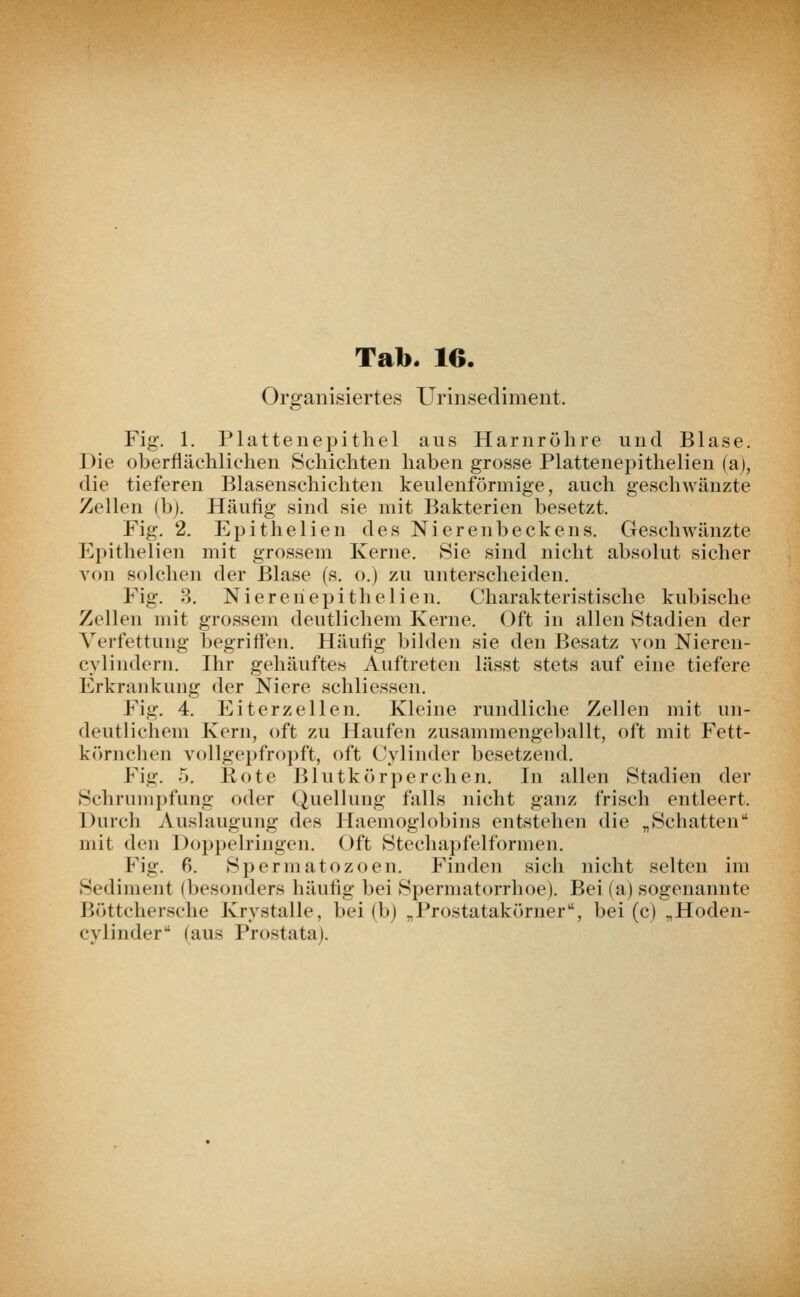 Organisiertes Urinsediment. Fig. 1. Plattenepithel aus Harnröhre und Blase. Die oberflächlichen Schichten haben grosse Plattenepithelien (a|, die tieferen Blasenschichten keulenförmige, auch geschwänzte Zellen (b). Häufig sind sie mit Bakterien besetzt. Fig. 2. Epithelien des Nierenbeckens. Geschwänzte Epithelien mit grossem Kerne. Sie sind nicht absolut sicher von solchen der Blase (s. o.j zu unterscheiden. Fig. 8. Niereh epithelien. Charakteristische kubische Zellen mit grossem deutlichem Kerne. Oft in allen Stadien der Verfettung begriffen. Häufig bilden sie den Besatz von Nieren- cylindern. Ihr gehäuftes Auftreten lässt stets auf eine tiefere Erkrankung der Niere schliessen. Fig. 4. Eiterzellen. Kleine rundliche Zellen mit un- deutlichem Kern, oft zu Haufen zusammengeballt, oft mit Fett- körnchen vollgepfropft, oft Cylinder besetzend. Fig. •>. Rote Blutkörperchen. In allen Stadien der Schrumpfung oder Quellung falls nicht ganz frisch entleert. Durch Auslaugung des Haemoglobins entstehen die „Schatten1' mit den Doppelringen. Oft Stechapfelformen. Fig. ß. Spermatozoen. Finden sich nicht selten im Sediment (besonders häufig bei Spermatorrhoe). Bei (a) sogenannte Böttchersche Krystalle, bei (b) „Prostatakörner, bei (c) „Hoden- cylinder (aus Prostata).