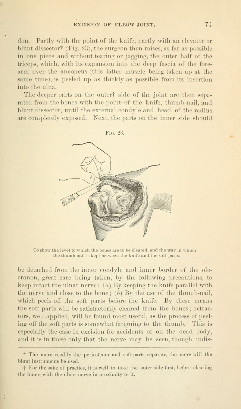 don. Partly with the point of the knife, partly with an elevator or blunt dissector* (Fig. 23), the surgeon then raises, as far as possible in one piece and without tearing or jagging, the outer half of the triceps, Avhich, with its expansion into the deep fascia of the fore- arm over the anconeus (this latter muscle being taken up at the same time), is peeled up as thickly as possible from its insertion into the ulna. The deeper parts on the outerf side of the joint are then sepa- rated from the bones with the point of the knife, thumb-nail, and blunt dissector, until the external condyle and head of the radius are completely exposed. Next, the parts on the inner side should Fig. 23. To show the level to which the bones are to be cleared, and the way in which the thumb-nail is kept between the knife and the soft parts. be detached from the inner condyle and inner border of the ole- cranon, great care being taken, by the following precautions, to keep intact the ulnar nerve: (a) By keeping the knife parallel with the nerve and close to the bone; (6) By the use of the thumb-nail, which peels off the soft parts before the knife. By these means the soft parts will be satisfactorily cleared from the bones; retrac- tors, well applied, will be found most useful, as the process of peel- ing off the soft parts is somewhat fatiguing to the thumb. This is especially the case in excision for accidents or on tlie dead body, and it is in these only that the nerve may be seen, though indis- * The more readily the periosteum and soft parts separate, the more will the blunt instruments be used. t For the sake of practice, it is well to take the outer side first, before clearing the inner, with the ulnar nerve in proximity to it.