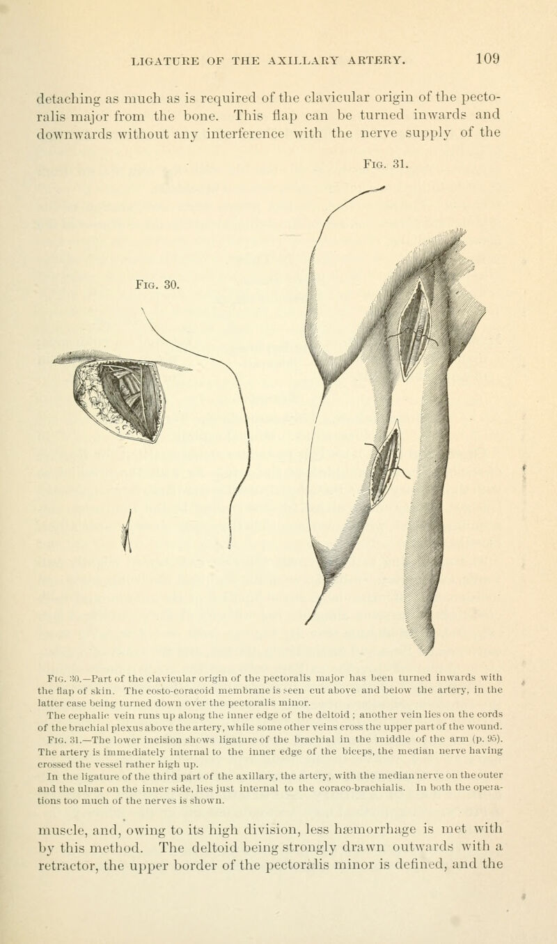 detaching as much as is required of the clavicular origin of the pecto- ralis major from the bone. This flap can be turned inwards and downwards without any interference with the nerve supply of the Fig. 3L Fig. :W.—Part of the clavicular origin of the pectoralis major has been turned inwards with the flap of skin. The costo-coracoid membrane is seen cut above and below the artery, in the latter case being turned down over the pectoralis minor. The cephalic vein runs up along the inner edge of the deltoid ; another vein lies on the cords of the brachial plexus above the artery, while some other veins cross the upper part of the wound. Fig. 31.—The lower incision shows ligature of the brachial in the middle of the arm (p. 95). The artery is immediately internal to the inner edge of the biceps, the median nerve having crossed the vessel rather high up. In the ligature of the third part of the axillary, the artery, with the median nerve on the outer and the ulnar on the inner side, lies just internal to the coraco-brachialis. In both the opeia- tions too much of the nerves is shown. muscle, and, owing to its high division, less haemorrhage is met with by this method. The deltoid being strongly drawn outAvards with a retractor, the upper border of the pectoralis minor is defined, and the