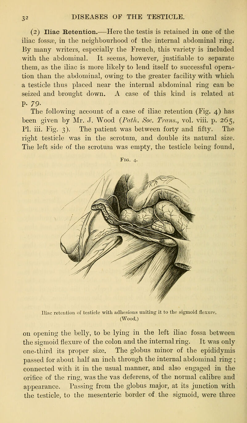 (2) Iliac Betention.—Here the testis is retained in one of the iliac fossie, in the neighbourhood of the internal abdominal ring. By many writers, especially the French, this variety is included with the abdominal. It seems, however, justifiable to separate them, as the iliac is more likely to lend itself to successful opera- tion than the abdominal, owing to the greater facility with which a testicle thus placed near the internal abdominal ring can be seized and brought down. A case of this kind is related at p. 79- The following account of a case of iliac retention (Fig. 4) has been given by Mr. J. Wood {Pcdh. Soc. Trans., vol. viii. p. 265, PI. iii. Fig. 3). The patient was between forty and fifty. The right testicle was in the scrotum, and double its natural size. The left side of the scrotum was empty, the testicle being found, ri&. 4. Iliac retention of testicle with adhesions uniting it to the sigmoid flexure. (Wood.) on opening the belly, to be lying in the left iliac fossa between the sigmoid flexure of the colon and the internal ring. It was only one-third its proper size. The globus minor of the epididymis passed for about half an inch through the internal abdominal ring ; connected with it in the usual manner, and also engaged in the orifice of the ring, was the vas deferens, of the normal calibre and appearance. Passing from the globus major, at its junction with the testicle, to the mesenteric border of the sigmoid, were three