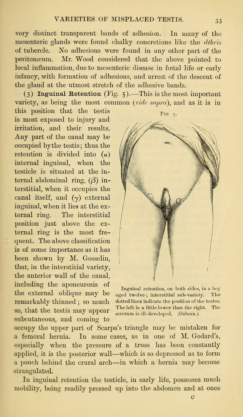very distinct transparent bands of adhesion. In many of the mesenteric glands were found chalky concretions like the debris of tubercle. No adhesions were found in any other part of the peritonaeum. Mr. Wood considered that the above pointed to local inflammation, due to mesenteric disease in foetal life or early infancy, with formation of adhesions, and arrest of the descent of the gland at the utmost stretch of the adhesive bands. (3) Inguinal Retention (Fig. 5).—This is the most important variety, as being the most common (vide stipra), and as it is in this position that the testis p^^^ ^ is most exposed to injury and irritation, and their results. Any part of the canal may be occupied by the testis; thus the retention is divided into (a) internal inguinal, when the testicle is situated at the in- ternal abdominal ring, ()3) in- terstitial, when it occupies the canal itself, and (y) external inguinal, when it lies at the ex- ternal ring. The interstitial position just above the ex- ternal ring is the most fre- quent. The above classification is of some importance as it has been shown by M. Gosselin, that, in the interstitial variety, the anterior wall of the canal, including the aponeurosis of the external oblique may be remarkably thinned ; so much so, that the testis may appear subcutaneous, and coming to occupy the upper part of Scarpa's triangle may be mistaken for a, femoral hernia. In some cases, as in one of M. Godard's, especially when the pressure of a truss has been constantly applied, it is the posterior wall—which is so depressed as to form a pouch behind the crural arch—in which a hernia may become, strangulated. In inguinal retention the testicle, in early life, possesses much mobility, being readily pressed up into the abdomen and at once c Inguinal retention, on both sides, in n boy aged twelve ; interstitial sub-variety. The dotted lines indicate the position of the testes. The left is a little lower than the I'ight. The scrotum is ill-developed. (Osborn.)