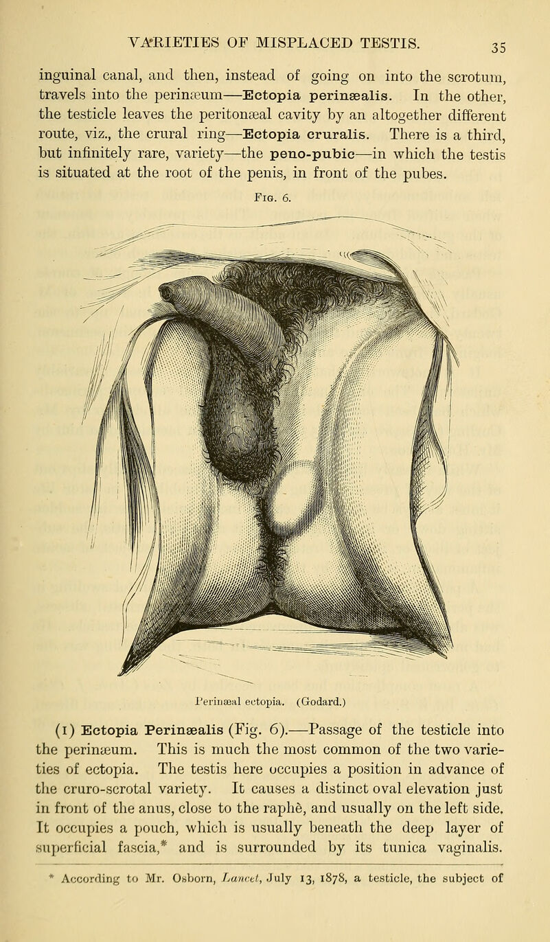 inguinal canal, and then, instead of going on into the scrotum, travels into the perineum—Ectopia perinsealis. In the other, the testicle leaves the peritonseal cavity by an altogether different route, viz., the crural ring—Ectopia cruralis. There is a third, but infinitely rare, variety—the peuo-pubie—in which the testis is situated at the root of the penis, in front of the pubes. Fig. 6. I'eiiiiseal ectopia. (Godard.) (i) Ectopia Perinsealis (Fig. 6).—Passage of the testicle into the perinteum. This is much the most common of the two varie- ties of ectopia. The testis here occupies a position in advance of the cruro-scrotal variety. It causes a distinct oval elevation just in front of the anus, close to the raph6, and usually on the left side. It occupies a pouch, which is usually beneath the deep layer of superficial fascia,* and is surrounded by its tunica vaginalis. * According to Mr. Obborn, Lwncul, July 13, 1878, a testicle, the subject of