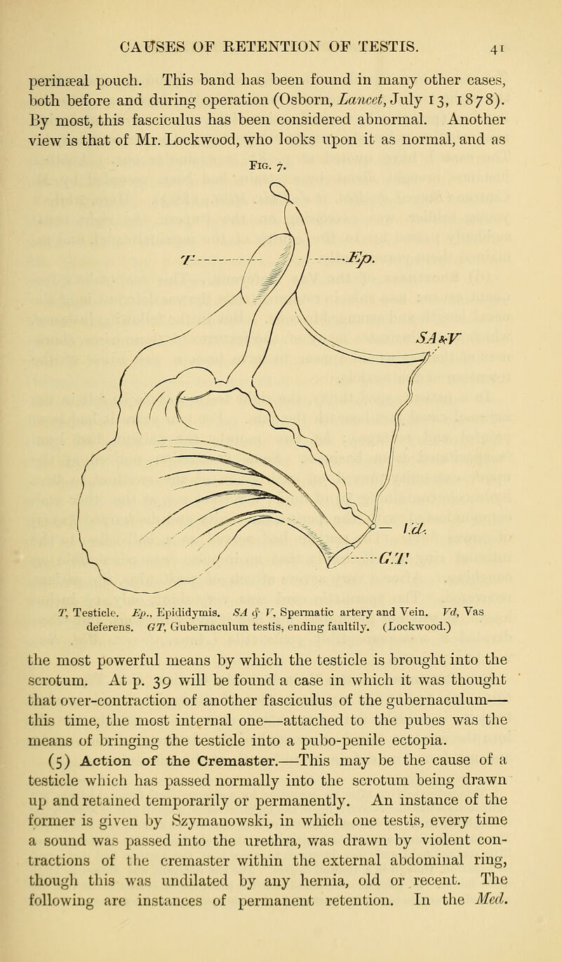 perinseal pouch. This band has been found in many other cases, both before and during operation (Osborn, Zawce^^, July 13, 1878). By most, this fascicuhis has been considered abnormal. Another view is that of Mr. Lock wood, who looks upon it as normal, and as Fig. 7. SJirV T, Testicle. Ep., Epididymis. -S^ cj- V, Spennatic artery and Vein. Vd, Vas deferens. GT, Gubemaculum testis, ending faultily. (Lockwood.) the most powerful means by which the testicle is brought into the scrotum. At p. 39 will be found a case in which it was thought that over-contraction of another fasciculus of the gubernaculum— this time, the most internal one—attached to the pubes was the means of bringing the testicle into a pubo-penile ectopia. (5) Action of the Cremaster.—This may be the cause of a testicle which has passed normally into the scrotum being drawn up and retained temporarily or permanently. An instance of the former is given by Szymanowski, in which one testis, every time a sound was passed into the urethra, v/as drawn by violent con- tractions of tlie cremaster within the external abdominal ring, though this was undilated by any hernia, old or recent. The following are instances of permanent retention. In the 3fcd.