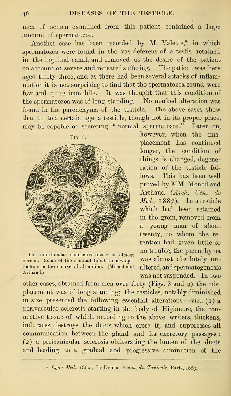 Fig. 8. men of semen examined from this patient contained a large amount of spermatozoa. Another case has been recorded by M. Valette,* in which spermatozoa were found in the vas deferens of a testis retained in the inguinal canal, and removed at the desire of the patient on account of severe and repeated suffering. The patient was Taere aged thirty-three, and as there had been several attacks of inflam- mation it is not surprising to find that the spermatozoa found were few and quite immobile. It was thought that this condition of the spermatozoa was of long standing. No marked alteration was found in the parenchyma of the testicle. The above cases show that up to a certain age a testicle, though not in its proper place, may be capable of secreting  normal spermatozoa. Later on, however, when the mis- placement has continued longer, the condition of things is changed, degene- ration of the testicle fol- lows. This has been well proved by MM. Monod and Arthaud {Arch. Gin. de Med., 1887). In a testicle which had been retained in the groin, removed from a young man of about twenty, to whom the re- tention had given little or ^, . , , , , . . . no trouble, the parenchyma The intertubular connective tissue is almost uoi-mal. borne of the seminal tubules show epi- WaS almost absolutely Un- thelium in the course of alteration. (Monod and altered, and Spermatogenesis Arthaud.) , , -p was not suspended. In two other cases, obtained from men over forty (Figs. 8 and 9), the mis- placement was of long standing; the testicles, notably diminished in size, presented the following essential alterations—viz., (i) a perivascular sclerosis starting in the body of Highmore, the con- nective tissue of which, according to the above writers, thickens, indurates, destroys the ducts which cross it, and suppresses all communication between the gland and its excretory passages ; (2) a pericanicular sclerosis obliterating the lumen of the ducts and leading to a gradual and progressive diminution of the * Liion Med., 1869 ; Le Dentu, Anom. du Testicule, Paris, 1869.