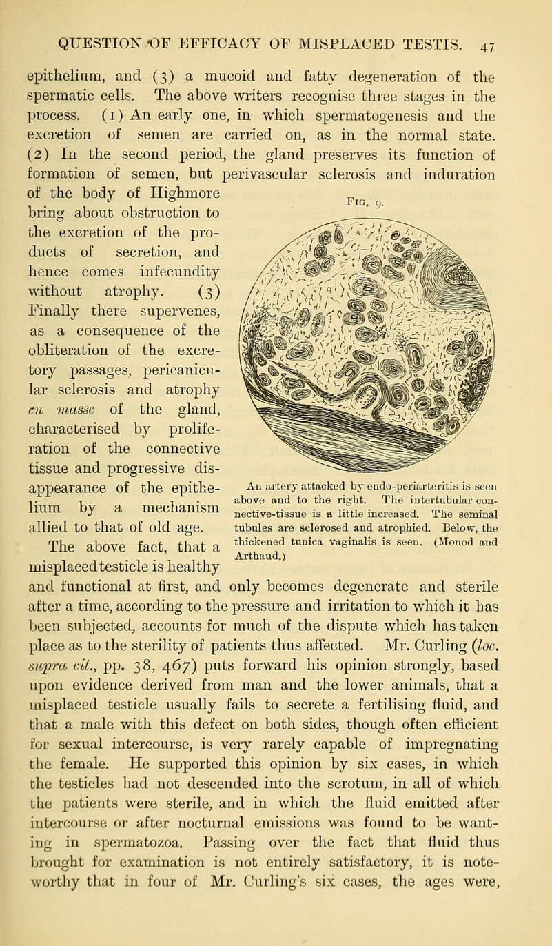 epithelium, and (3) a mucoid and fatty degeneration of the spermatic cells. The above writers recognise three stages in the process, (i) An early one, in which spermatogenesis and the excretion of semen are carried on, as in the normal state. (2) In the second period, the gland preserves its function of formation of semen, but perivascular sclerosis and induration of the body of Highmore '' °. Fig. 9. bring about obstruction to the excretion of the pro- ducts of secretion, and hence comes infecundity without atrophy. (3) rinally there supervenes, as a consequence of the obliteration of the excre- tory passages, pericanicu- lar sclerosis and atrophy t)i masse of the gland, characterised by prolife- ration of the connective tissue and progressive dis- appearance of the epithe- lium by a mechanism allied to that of old age. The above fact, that a misplaced testicle is healthy and functional at first, and only becomes degenerate and sterile after a time, according to the pressure and irritation to which it has been subjected, accounts for much of the dispute which has taken place as to the sterility of patients thus affected. Mr. Curling (loc. supra cit., pp. 38, 467) puts forward his opinion strongly, based upon evidence derived from man and the lower animals, that a misplaced testicle usually fails to secrete a fertilising fluid, and that a male with this defect on both sides, though often efficient for sexual intercourse, is very rarely capable of impregnating tlie female. He supported this opinion by six cases, in wdiich the testicles had not descended into the scrotum, in all of which the patients were sterile, and in which the fluid emitted after intercourse or after nocturnal emissions was found to be want- ing in spermatozoa. Passing over the fact that thiid thus brought for examination is not entirely satisfactory, it is note- worthy that in four of Mr. Curling's six cases, the ages were, An artery attacked by endo-periarteritis is seen above and to the right. The intertubular con- nective-tissue is a little increased. The seminal tubules are sclerosed and atrophied. Below, the thickened tunica vaginalis is seen. (Monod and Arthaud.)