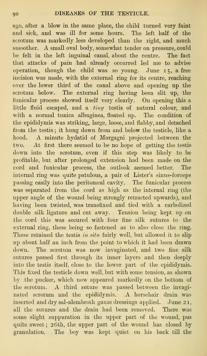 ago, after a blow in the same place, the child turned very faint and sick, and was ill for some hours. The left half of the scrotum was markedly less developed than the right, and much smoother. A small oval body, somewhat tender on pressure, could be felt in the left inguinal canal, about the centre. The fact that attacks of pain had already occurred led me to advise operation, though the child was so young. June 15, a free incision was made, with the external ring for its centre, reaching over the lower third of the canal above and opening up the scrotum below. The external ring having been slit up, the funicular process showed itself very clearly. On opening this a little fluid escaped, and a tiny testis of natural colour, and with a normal tunica albuginea, floated up. The condition of the epididymis was striking, large, loose, and flabby, and detached from the testis; it hung down from and below the testicle, like a hood. A minute hydatid of Morgagni projected between the two. At first there seemed to be no hope of getting the testis down into the scrotum, even if this step was likely to be profitable, but after prolonged extension had been made on the cord and funicular process, the outlook seemed better. The internal ring was quite patulous, a pair of Lister's sinus-forceps passing easily into the peritonseal cavity, The funicular process was separated from the cord as high as the internal ring (the upper angle of the wound being strongly retracted upwards), and having been twisted, was transfixed and tied with a carbolized double silk ligature and cut away. Tension being kept up on the cord this was secured with four fine silk sutures to the external ring, these being so fastened as to also close the ring. These retained the testis in situ fairly well, but allowed it to slip up about half an inch from the point to which it had been drawn down. The scrotum was now invaginated, and two fine silk sutures passed first through its inner layers and then deeply into the testis itself, close to the lower part of the epididymis. This fixed the testicle down well, but with some tension, as shown by the pucker, which now appeared markedly on the bottom of the scrotum. A third suture was passed between the invagi- nated scrotum and the epididymis. A horsehair drain was inserted and dry sal-alembroth gauze dressings applied. June 2 i, all the sutures and the drain had been removed. There was some slight suppuration in the upper part of the wound, pus quite sweet; 26th, the upper part of the wound has closed by granulation. The boy was kept quiet on his back till the