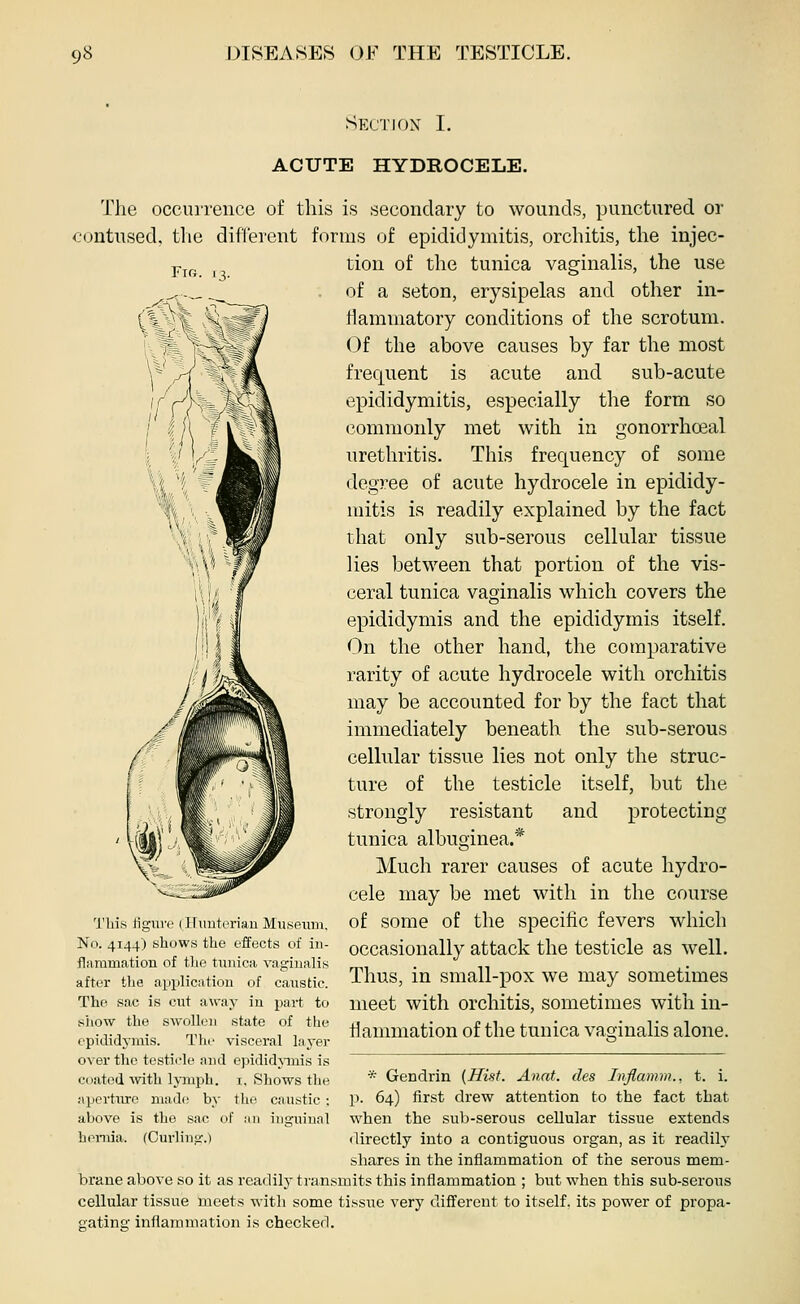 SfX'TIOX I. ACUTE HYDROCELE. Fig. '3- The occuiTence of this is secondary to wounds, punctured or contused, the different forms of epididymitis, orchitis, the injec- tion of the tunica vaginalis, the use of a seton, erysipelas and other in- flammatory conditions of the scrotum. Of the above causes by far the most frequent is acute and sub-acute epididymitis, especially the form so commonly met with in gonorrhoeal urethritis. This frequency of some degree of acute hydrocele in epididy- mitis is readily explained by the fact that only sub-serous cellular tissue lies between that portion of the vis- ceral tunica vaginalis which covers the epididymis and the epididymis itself. On the other hand, the comparative rarity of acute hydrocele with orchitis may be accounted for by the fact that immediately beneath the sub-serous cellular tissue lies not only the struc- ture of the testicle itself, but the strongly resistant and protecting tunica albuginea.* Much rarer causes of acute hydro- cele may be met with in the course of some of the specific fevers which occasionally attack the testicle as well. Thus, in small-pox we may sometimes meet with orchitis, sometimes with in- flammation of the tunica vaginalis alone. Thifs ligiire (iriiutyrian Museum. No. 4144) shows the effects of iu- fliimmation of the tunica vagiualis after the a^jplication of caustic. The sac is cut away in part to sjiow the swollen state of the epididymis. The visceral layer over the testicle and epididjTnis is coated mth lymph, i. Shows the * Gendrin [Hist. Anat. cles Inflamm., t. i. aperture made by the caustic ; P- 64) first drew attention to the fact that above is the sac of an inguinal when the sub-serous cellular tissue extends honiia. (Curling.) directly into a contiguous organ, as it readih' shares in the inflammation of the serous mem- brane above so it as readily transmits this inflammation ; but when this sub-serous cellular tissue meets with some tissue very different to itself, its power of propa- gating inflammation is checker).