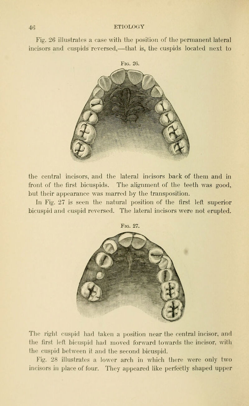 Fig. 26 illustrates a case with the position of the permanent lateral incisors and cuspids reversed,—that is, the cuspids located next to Fig. 26. the central incisors, and the lateral incisors back of them and in front of the first bicuspids. The alignment of the teeth was good, but their appearance was marred by the transposition. In Fig. 27 is seen the natural position of the first letl superior bicuspid and cuspid reversed. The lateral incisors were not erupted. Fig. 27. The right cuspid had taken a po.sition near the central incisor, and the first left bicuspid had moved forward towards the incisor, with the cuspid between il and the second bicuspid. Fig. 28 illustrah's a lower arch in which there were only two incisors in place of four. They appeared like perfectly shaped upper