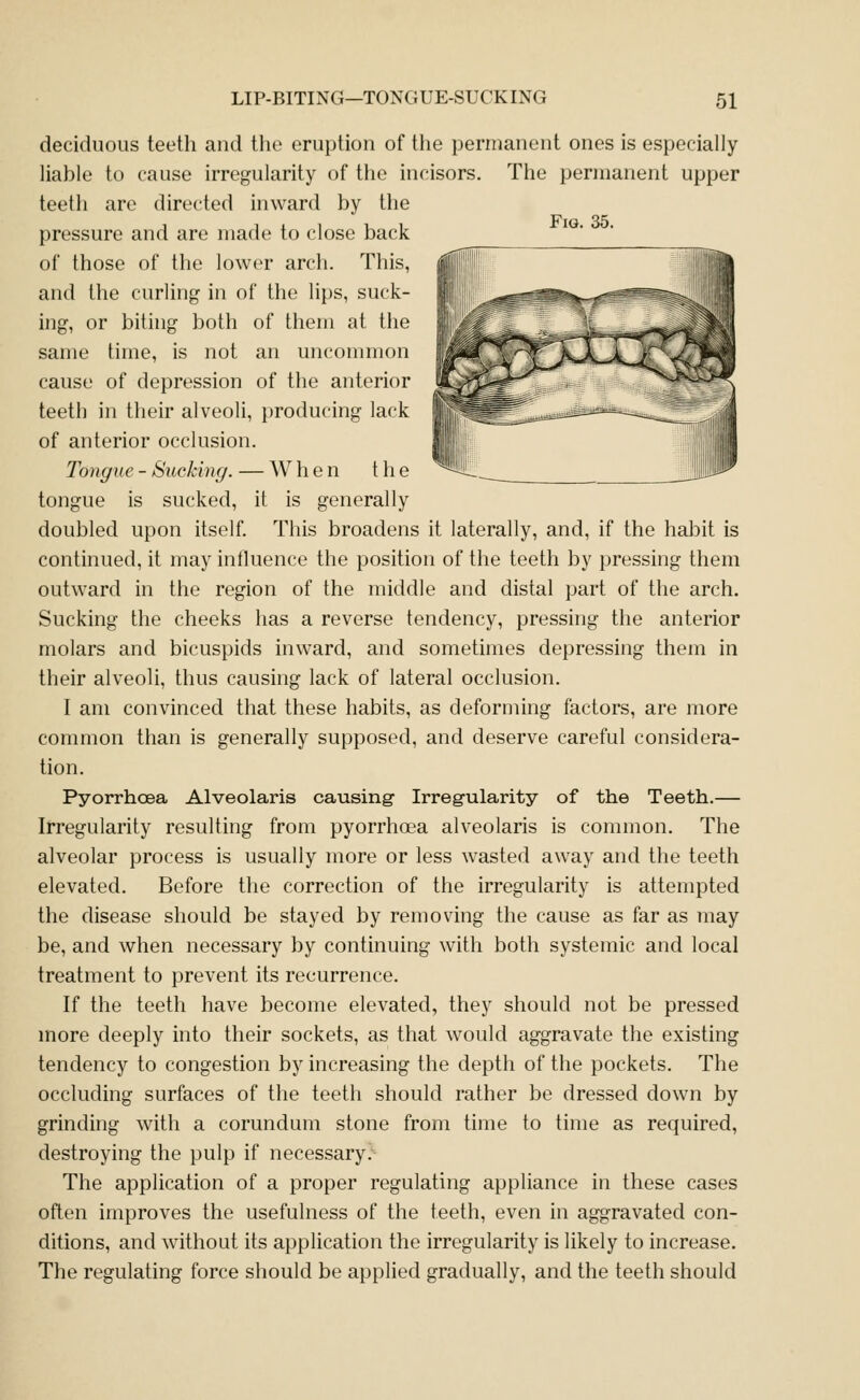 Fig. 35. deciduous teeth and the eruption of the permanent ones is especially liable to cause irregularity of the incisors. The permanent upper teeth are directed inward by the pressure and are made to close back of those of the lower arch. This, and the curling in of the lips, suck- ing, or biting both of them at the same time, is not an unconmion cause of depression of the anterior teeth in their alveoli, producing lack of anterior occlusion. Tongue - Sucking. — When t h e tongue is sucked, it is generally doubled upon itself. This broadens it laterally, and, if the habit is continued, it may influence the position of the teeth by pressing them outward in the region of the middle and distal part of the arch. Sucking the cheeks has a reverse tendency, pressing the anterior molars and bicuspids inward, and sometimes depressing them in their alveoli, thus causing lack of lateral occlusion. I am convinced that these habits, as deforming factors, are more common than is generally supposed, and deserve careful considera- tion. Pyorrhoea Alveolaris causing- Irregularity of the Teeth.— Irregularity resulting from pyorrhoea alveolaris is common. The alveolar process is usually more or less wasted away and the teeth elevated. Before the correction of the irregularity is attempted the disease should be stayed by removing the cause as far as may be, and when necessary by continuing with both systemic and local treatment to prevent its recurrence. If the teeth have become elevated, they should not be pressed more deeply into their sockets, as that would aggravate the existing tendency to congestion by increasing the depth of the pockets. The occluding surfaces of the teeth should rather be dressed down by grinding with a corundum stone from time to time as required, destroying the pulp if necessary. The application of a proper regulating appliance in these cases often improves the usefulness of the teeth, even in aggravated con- ditions, and without its application the irregularity is likely to increase. The regulating force should be applied gradually, and the teeth should