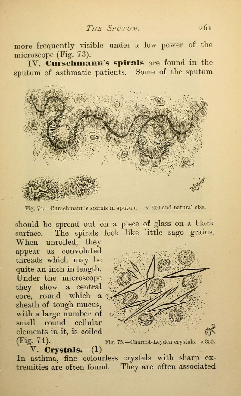 more frequently visible under a low power of the microscope (Fig. 73). IV. Ciirsclmiaiiii's spirals are found in the sputum of asthmatic patients. Some of the sputum 'm^^- Fig. 74.—Cursehmaun's spirals in sputum, x 200 and natural size. should be spread out on a piece of glass on a black sui-face. The spirals look like little sago grains. When unrolled, they appear as convoluted threads which may be quite an inch in length. ,, .^5^^,^ IJnder the microscope ■; ;P ^ they show a central •;;.-.. core, round which a K:^^^^^'- sheath of tough mucus, with a large number of ',---^ ^^ small round cellular elements in it, is coiled (Fig. 74). Fig. 75.—Charcot-Leyden crystals. x350. V. Crystals.—(1) In asthma, fine colourless crystals wdth sharp ex- tremities are often found. They are often associated