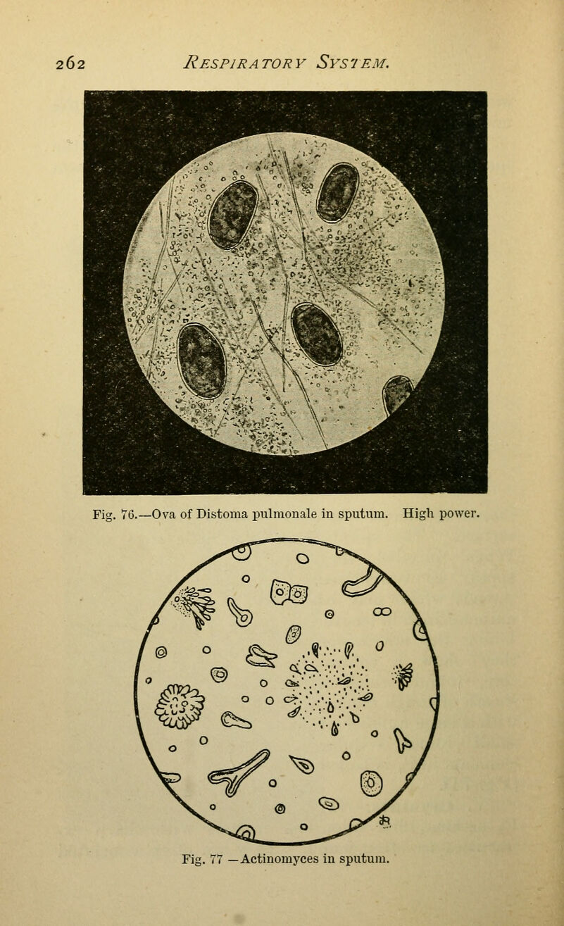 Fig. 76.—Ova of Distoma pulmonale in sputum. High power. Fig. 77 —Actinomyces in sputum.