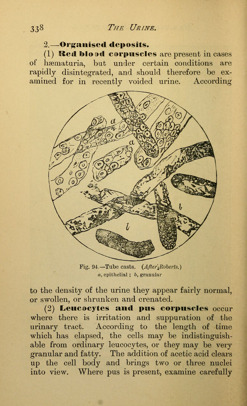 2.—Orjfaiiised depoisits. (1) Red blo»d corpuscles are present in cases of haematuria, but under certain conditions are rapidly disintegrated, and should therefore be ex- amined for in recently voided urine. According Fig. 94,—Tube casts. (After'iRoberts.) a, epithelial; b, granular to the density of the urine they appear fairly normal, or swollen, or shrunken and crenated. (2) Leucocytes a^nd pus corpuscles occur where there is irritation and suppuration of the urinary tract. According to the length of time which has elapsed, the cells may be indistinguish- able from ordinary leucocytes, or they may be very granular and fatty. The addition of acetic acid clears up the cell body and brings two or three nuclei iiito view. Where pus is present, examine carefully