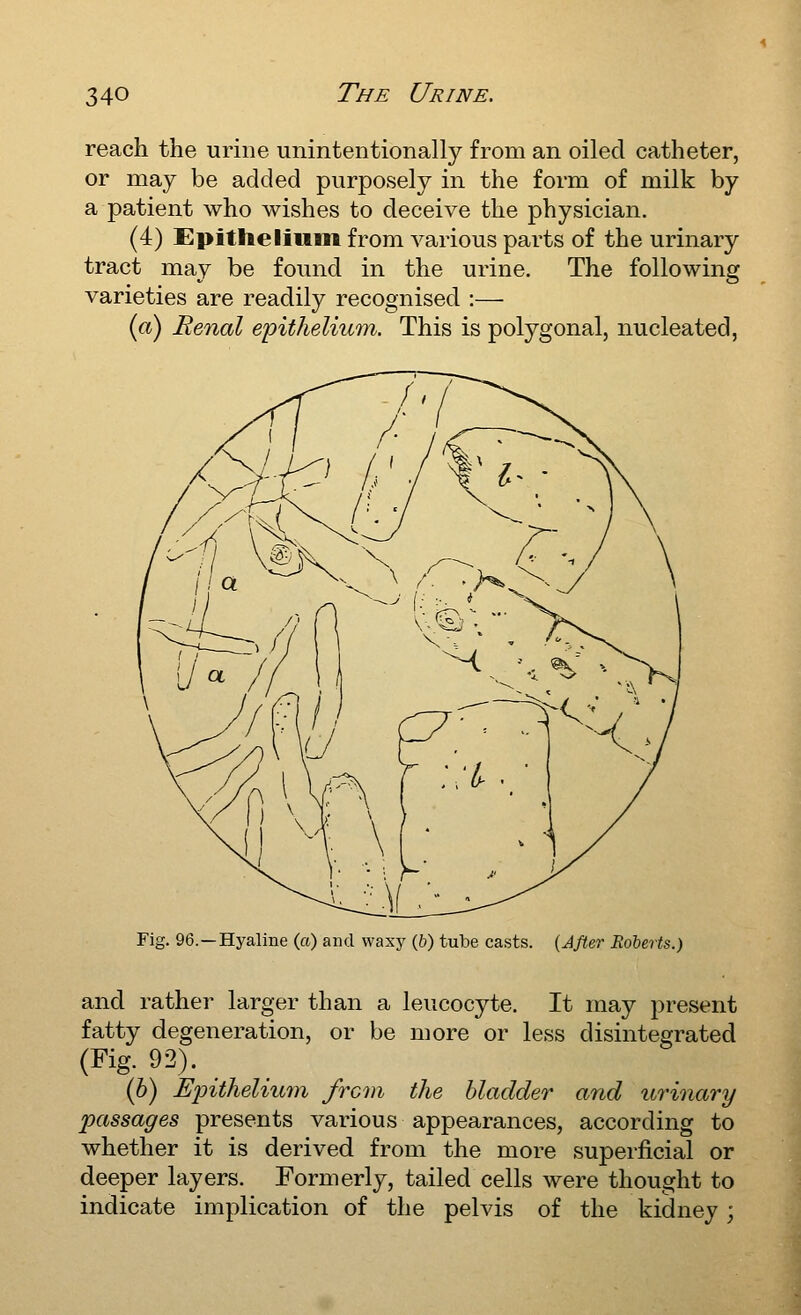 reach the urine unintentionally from an oiled catheter, or may be added purposely in the form of milk by a patient who wishes to deceive the physician. (4) Epithelium from various parts of the urinary tract may be found in the urine. The following varieties are readily recognised :— {a) Renal epithelium,. This is polygonal, nucleated, Fig. 96.—Hyaline (a) and waxy (6) tube casts. (J/fer Boherts.) and rather larger than a leucocyte. It may present fatty degeneration, or be more or less disintegrated (Fig. 92). (6) Epithelium from the bladder and urhiary passages presents various appearances, according to whether it is derived from the more superficial or deeper layers. Formerly, tailed cells were thought to indicate implication of the pelvis of the kidney;