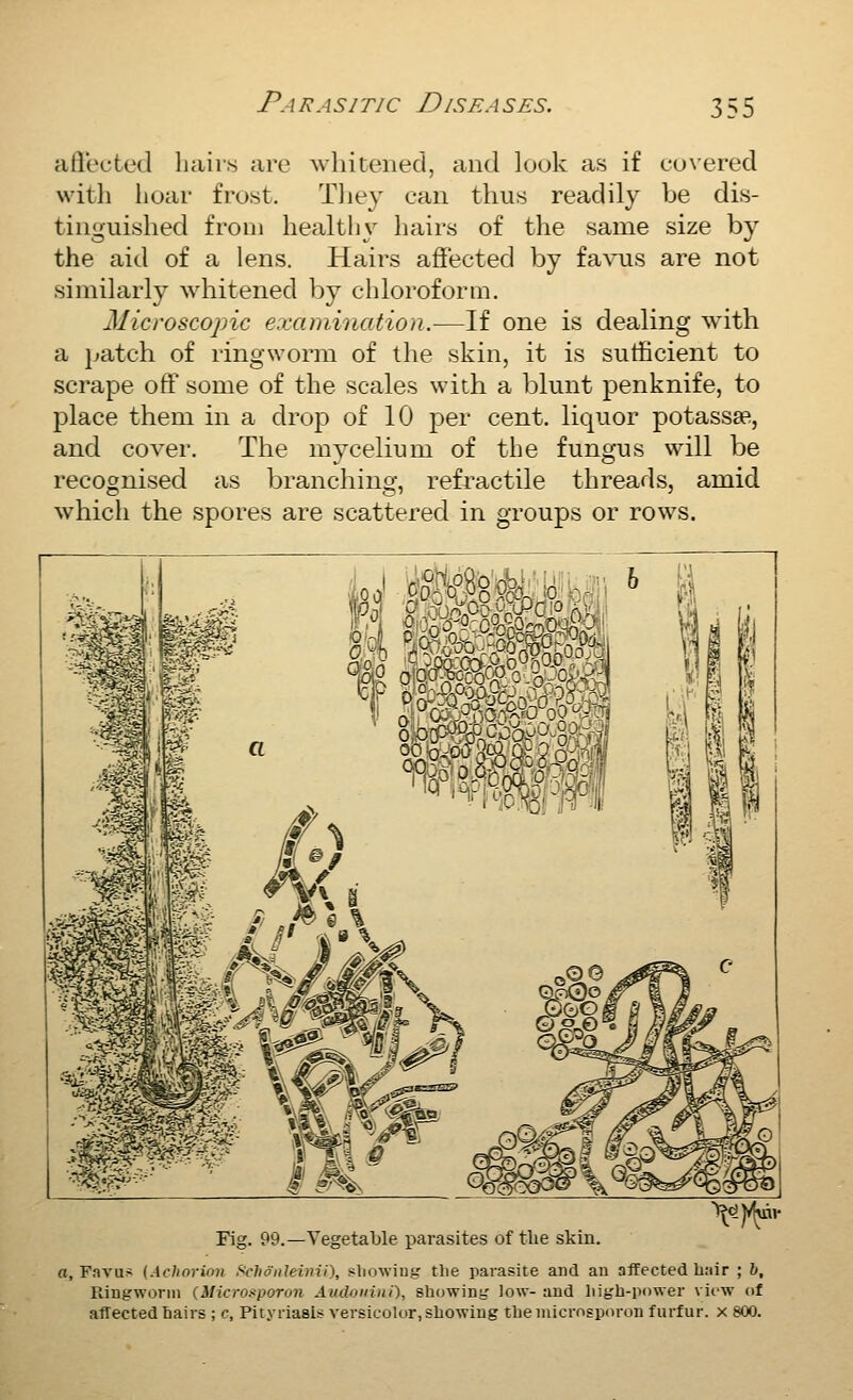afiected liaiis are Avhitened, and louk as if cuxered witli Iiuar frost. Tliey can thus readily be dis- tinguished from healthy liairs of the same size by the aid of a lens. Hairs affected by favus are not similarly whitened by chloroform. Microscopic examination.—If one is dealing with a j^atch of ringwoiTQ of the skin, it is sufficient to scrape off some of the scales with a blunt penknife, to place them in a drop of 10 per cent, liquor potassse, and cover. The mycelium of the fungus will be recognised as branching, refractile threads, amid whicli the spores are scattered in groups or rows. Fig. 99.—Vegetable parasites of tlie skin. a, Favus {Achorion Schonleivii), sliowiufr the parasite and an affected liair ; b. Ringworm (Micro^poron Audoiiini), showing low- and liigh-power viow of affected hairs ; c, Pityriasis versicolor, showing theniicrosporon furfur, x 800.
