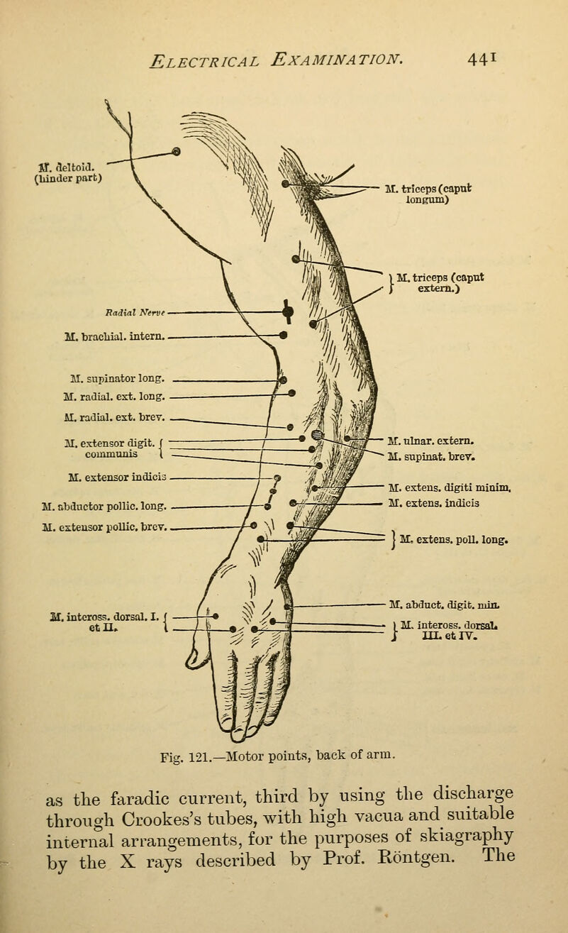 ff. fleltoia. (lunder part) Fadiat Kerv M. bracliial. intern. M. supinator long. M. radial, est. long, AI, radial, est. brev. 11. extensor digit, communis M. extensor indicis M. abductor pollic. long. M. esteusor pollic, brcT. H. intcross. doisol. I etn. M. triceps (caput longum) M. triceps (caput extern.) M. ulnar, extern. M. supinat. brev. M. extens. digiti minim, M. extens, indicis I M, extens. poll. long. M. abduct, digit, min. 1 M. inteross. dorsaU j IILetlY. Fig. 121.—Motor points, back of arm. as tlie faradic current, third by using the discharge through Crookes's tubes, with high vacua and suitable internal arrangements, for the purposes of skiagraphy by the X rays described by Prof. Rontgen. The