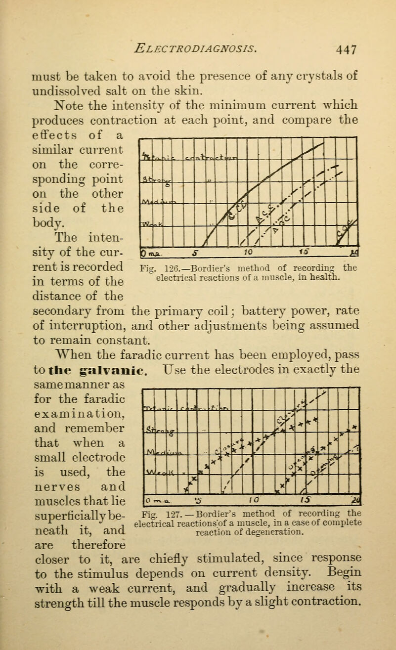 ^L T i Tit J^ — 1 /• ^ /^ ' ..-^ ■% << / r - /- / i' y / / / rr / 0 mA. S JO <3 ^ Fig. 126.—Bordier's method of recording the electiieal reactions of a muscle, in health. must be taken to avoid the presence of any crystals of undissolved salt on the skin. Note the intensity of the miniinuin current which produces contraction at each point, and compare the effects of a similar current on the corre- sponding point on the other side of the body. The inten- sity of the cur- rent is recorded in terms of the distance of the secondary from the primary coil; battery power, rate of interruption, and other adjustments being assumed to remain constant. When the faradic current has been employed, pass to the g-alvanic. Use the electrodes in exactly the same manner as for the faradic examination, and remember that when a small electrode is used, the nerves and muscles that lie super ticially be- neath it, and are therefore closer to it, are chiefly stimulated, since response to the stimulus depends on current density. Begin with a weak current, and gradually increase its strength till the muscle responds by a slight contraction. nf — t; A y' ^ r- *^t A: * ** * M i°H ,' .M * > / r r^' y ^x V ' -.^ ^A, |< X x' / / 0 i x .^ y X / / X t r O^.a. '5 10 IS 2<| Fig. 127.—Bordier's method of recording the electrical reactionspf a muscle, in a case of complete reaction of degeneration.