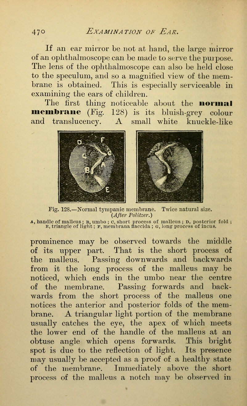 If an ear miiTor be not at hand, the large mirror of an ophthalmoscope can be made to serve the purpose. The lens of the ophthalmoscope can also be held close to the speculum, and so a magnihed view of the mem- brane is obtained. This is especially serviceable in examining the ears of children. The first membrane (Fig. 128) and translucency. A thing noticeable about the normal is its bluish-grey colour small white knuckle-like Fig. 128.—Normal tympanic membrane. Twice natural size. {After PoUtzer.) A, handle of malleus; b, umbo ; c, short process of malleus ; d, posterior fold ; E, triangle of light; f, merabrana flaccida ; G, long process of incus. prominence may be observed towards the middle of its upper part. That is the short process of the malleus. Passing downwards and backwards from it the long process of the malleus may be noticed, which ends in the umbo near the centre of the membrane. Passing forwards and back- wards from the short process of the malleus one notices the anterior and posterior folds of the mem- brane. A triangular light portion of the membrane usually catches the eye, the apex of which meets the lower end of the handle of the malleus at an obtuse angle which opens forwards. This blight spot is due to the reflection of light. Its presence may usually be accepted as a proof of a healthy state of the membrane. Immediately above the short process of the malleus a notch may be observed in
