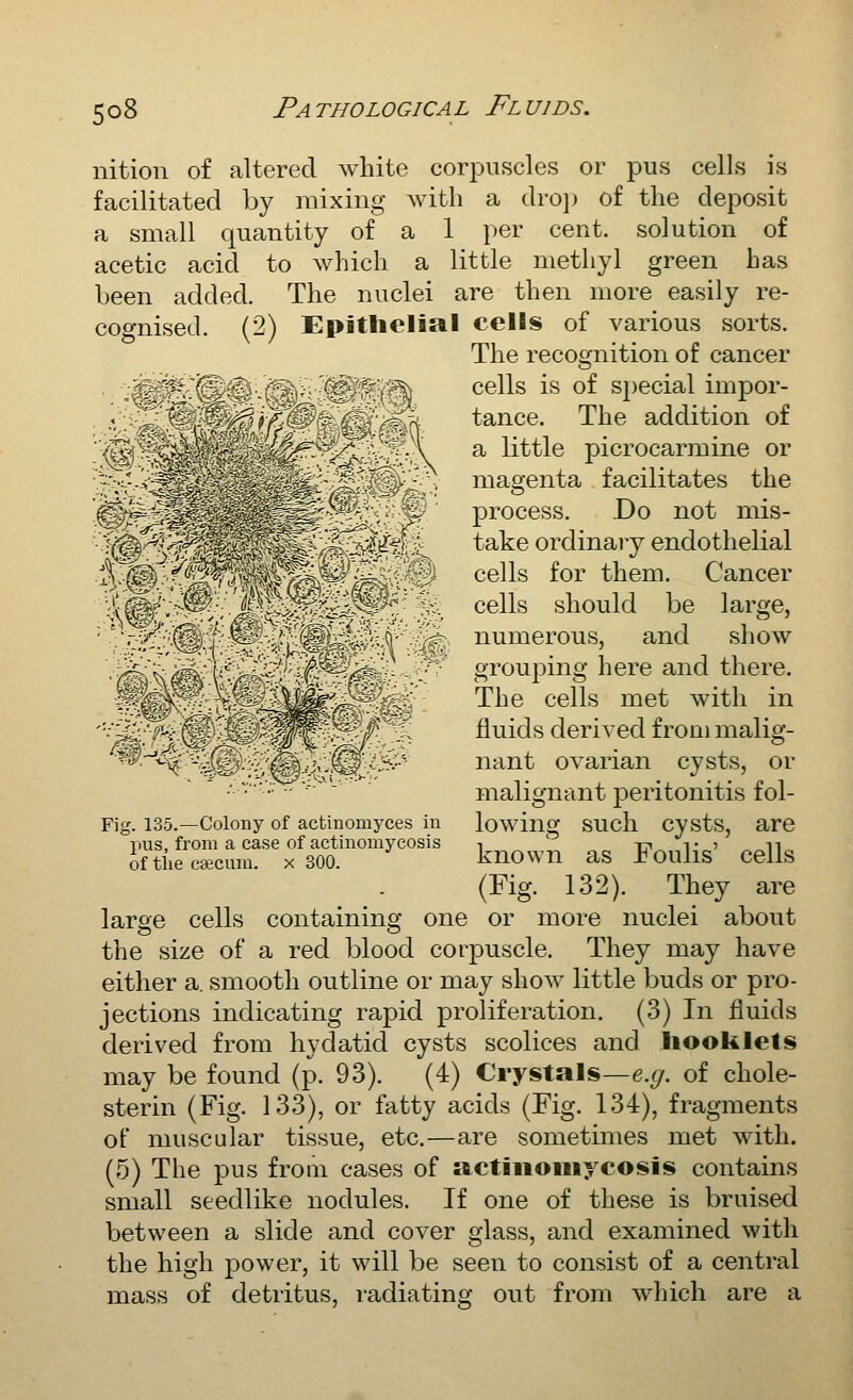 nition of altered white corpuscles or pus cells is facilitated by mixing with a dro]) of the deposit a small quantity of a 1 per cent, solution of acetic acid to which a little methyl green has been added. The nuclei are then more easily re- cognised. (2) Epithelial cells of various sorts. The recognition of cancer j - - cells is of special impor- f n, tance. The addition of ^ ; '^rA a little picrocarmine or magenta facilitates the process. .Do not mis- take ordinary endothelial cells for them. Cancer cells should be large, numerous, and show grouping here and there. The cells met with in fluids derived from malig- ^^^ W> -'v:-• '■ • '^^^^^^^^^ pus, from a case of actinomycosis of the csecum. x 300. nant ovarian cysts, or malignant peritonitis fol- Fig. 135.—Colony of actinomyces in lowing SUch Cysts, are known as Foulis' cells (Fig. 132). They are large cells containing one or more nuclei about the size of a red blood corpuscle. They may have either a. smooth outline or may show little buds or pro- jections indicating rapid proliferation. (3) In fluids derived from hydatid cysts scolices and liooklels may be found (p. 93). (4) Crystals—e.(/. of chole- sterin (Fig. 133), or fatty acids (Fig. 134), fragments of muscular tissue, etc.—are sometimes met with. (5) The pus from cases of actinomycosis contains small seedlike nodules. If one of these is bruised between a slide and cover glass, and examined with the high power, it will be seen to consist of a central mass of detritus, radiating out from which are a