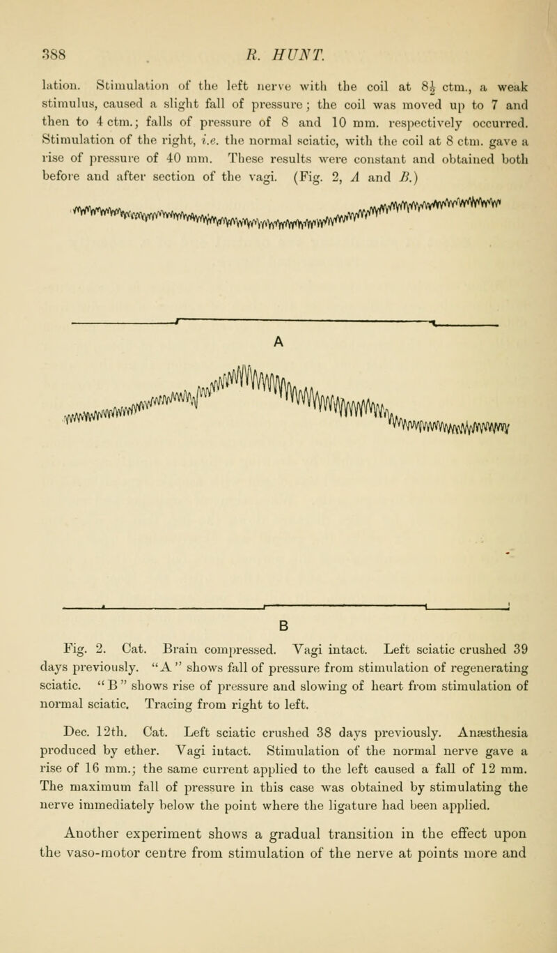 latiou. Stimulation of the left nerve with the coil at 8^ ctm., a weak stimulus, caused a slight fall of pressure ; the coil was moved up to 7 and then to 4 ctm.; falls of pressure of 8 and 10 mm. respecti^'ely occurred. Stimulation of the right, i.e. the normal sciatic, with the coil at 8 ctm. gave a rise of pressure of 40 mm. These results were constant and obtained both before and after section of the vagi. (Fig. 2, A and B.) .^^^^^r B Fig. 2. Cat. Brain compres.sed. Vagi intact. Left sciatic crushed 39 days previously. A shows fall of pressure from stimulation of regenerating sciatic. B shows rise of pressure and slowing of heart from stimulation of normal sciatic. Tracing from right to left. Dec. 12th. Cat. Left sciatic crushed 38 days previously. Anajsthesia produced by ether. Vagi intact. Stimulation of the normal nerve gave a rise of 16 mm.; the same current applied to the left caused a fall of 12 mm. The maximum fall of pressure in this case was obtained by stimulating the nerve immediately below the point where the ligature had been applied. Another experiment shows a gradual transition in the effect upon the vaso-motor centre from stimulation of the nerve at points more and