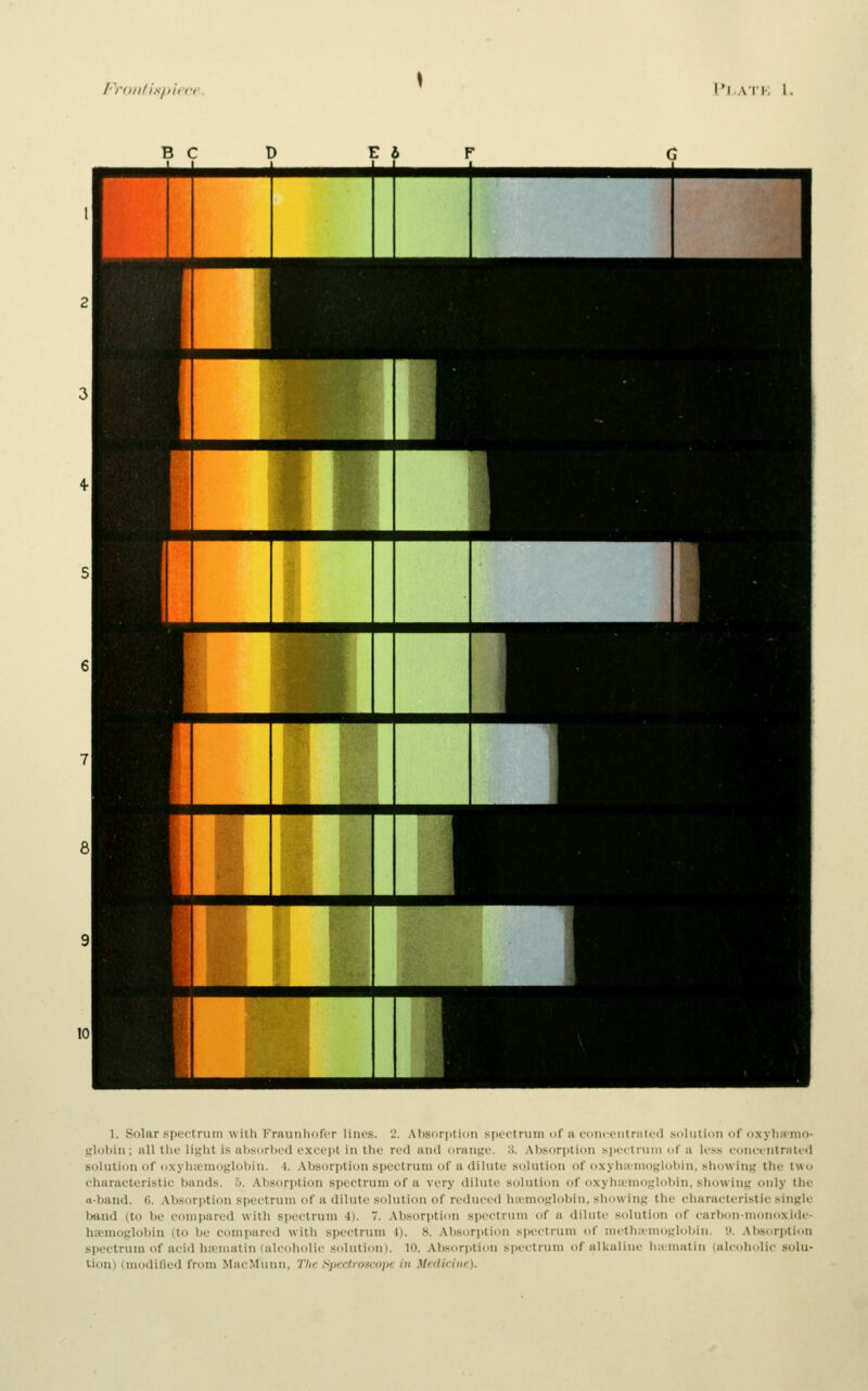 I'miiHs/iicfe, I'r ATK I, T 5 ( ** D E i I F G 1 r 2 3 vfm- .HHrass 4- i 1 mM^^^ 5 1 6 ■,-' ^ ^CVit •■ 1 l^^^JI^RllEllHi 1 7 r ^^H .^^ 8 4 i 1 9 i 1 1 10 1 J 1. Solar .spectrum w iili Fraunliofor lines. 'J. .Absdriitiim spectrum of a coiiceiitriilcd .soltitioii of oxylucmo- t;lol)iu; all tlie light is absorbed except in the red anil orange. S. .•Vbs()r])tion speclrnin of a le.ss concentrated solution of o.xyhamoglobin. 4. Absorption spectrum of a dilute solution of oxyhicmoglobin, showing the two characteristic bands, b. Absorption spectrum of a very dilute solution of oxyhicmoglobin, showing only the a-band. 6. Absorption spectrum of a dilute solution of reduced hivmoglobin. showing the characteristic single band (to be compared with spectrum 4). 7. Absorption spectrum of a dilute solution of carlxm-monoxide- hiemoglobin (to be compared with spectrum 1). S. Absorption spectrum of nieth;>nioglol)in. '.i. Absorption spectrum of acid hsematin (alcoholic solution). 10. Absorption spectrum of alkaline li;iniatin (alcoholic solu- tion) (modified from MacMunn, The Spectroscope in Medicine).